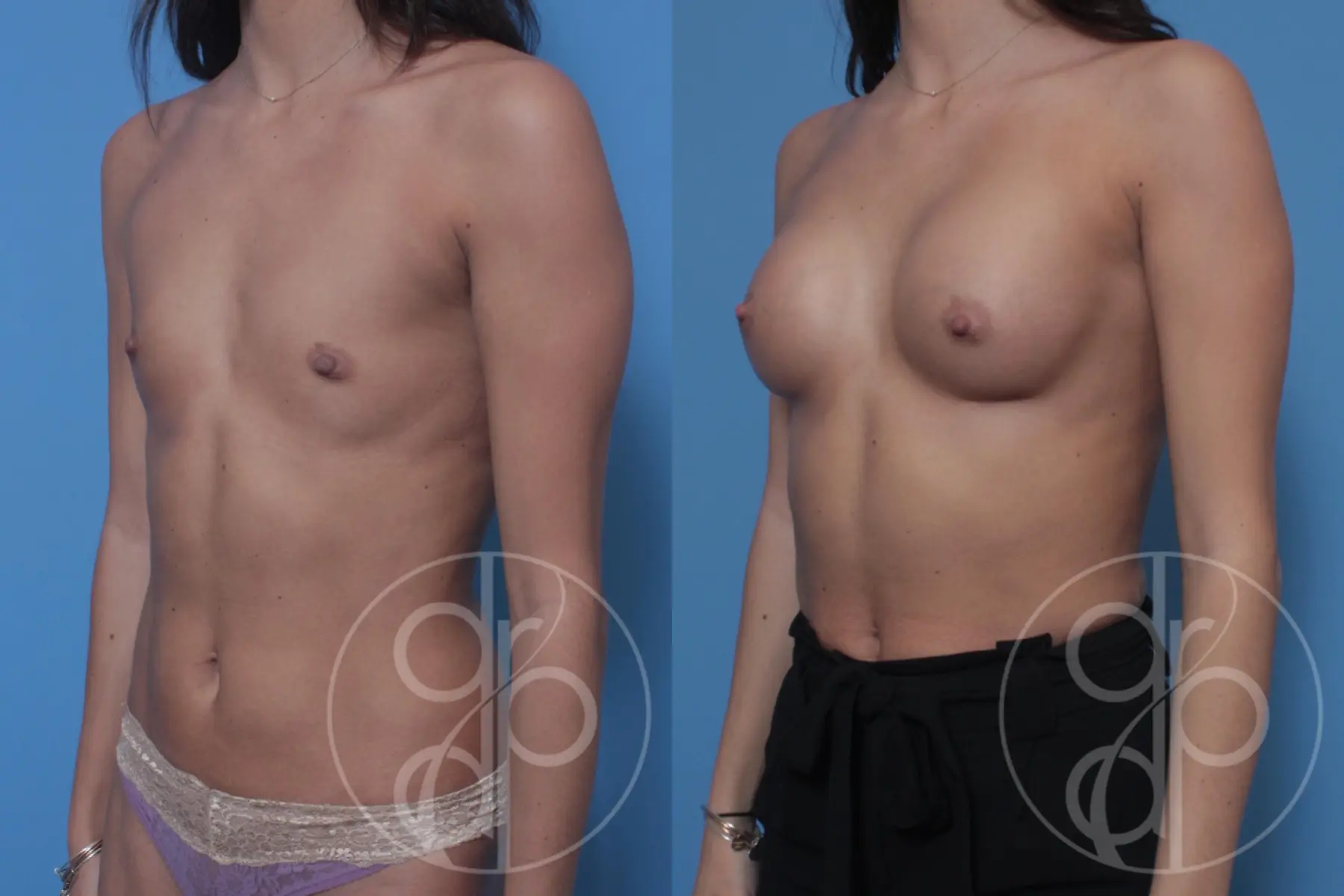 patient 10357 breast augmentation before and after result - Before and After 3