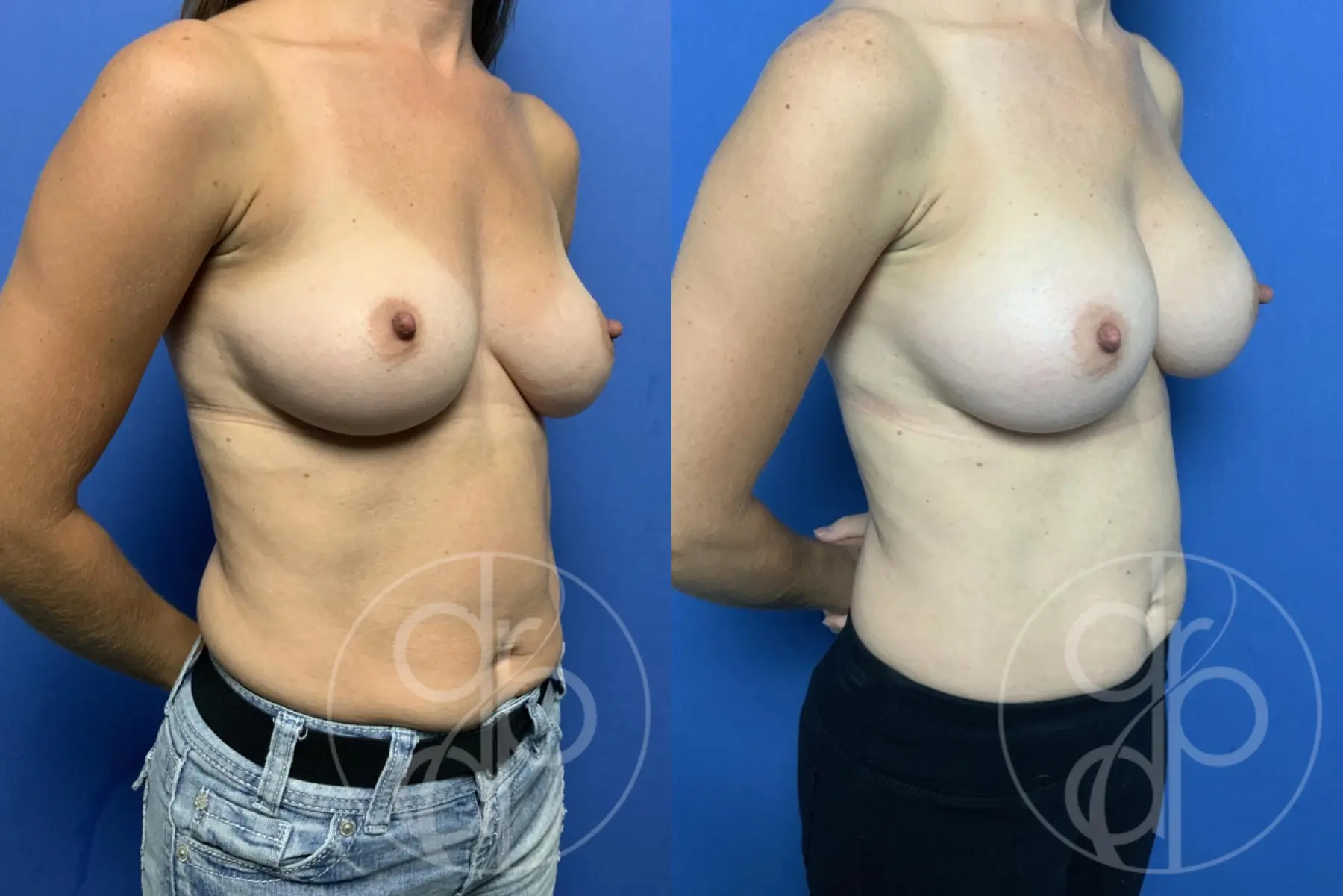 patient 12507 breast augmentation before and after result - Before and After 2