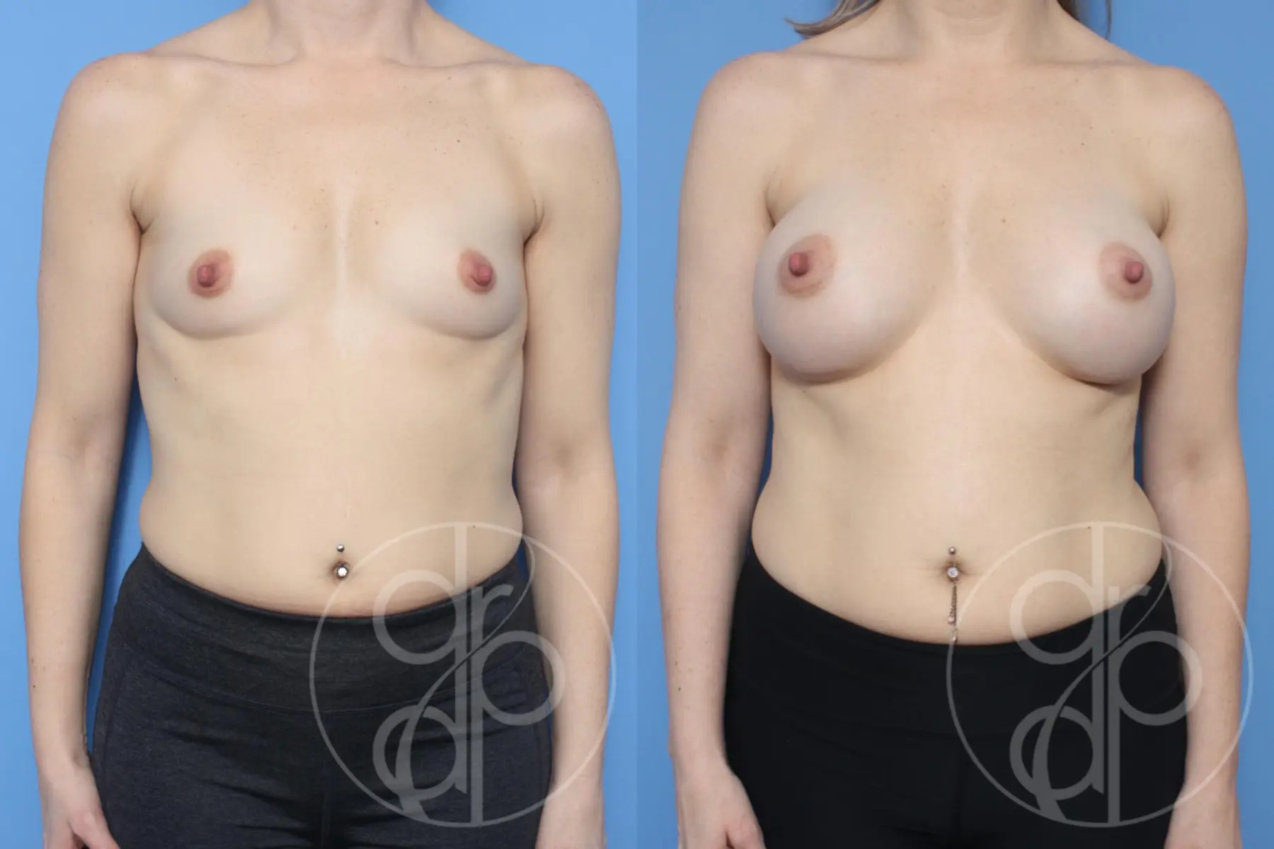 patient 14159 breast augmentation before and after result - Before and After 1