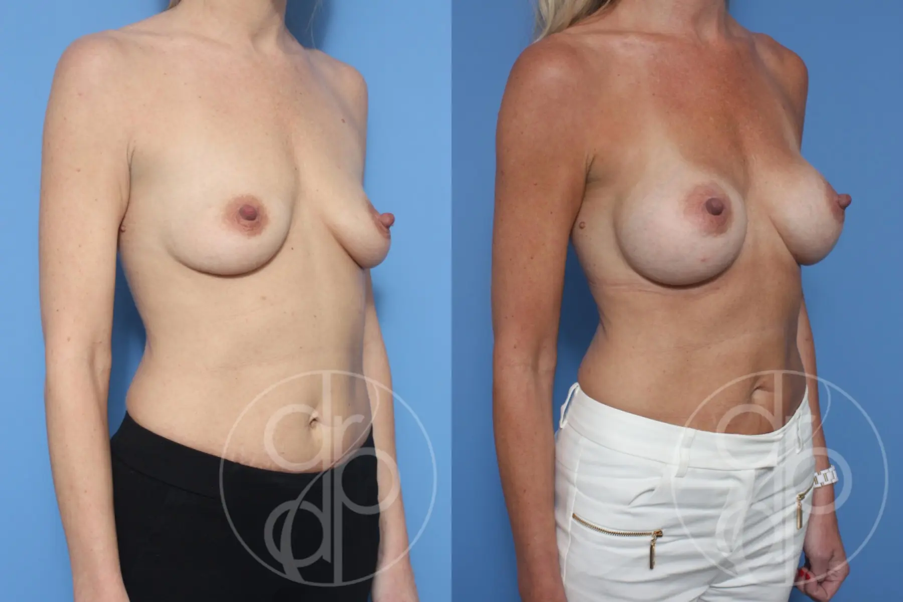 patient 13174 breast augmentation before and after result - Before and After 2