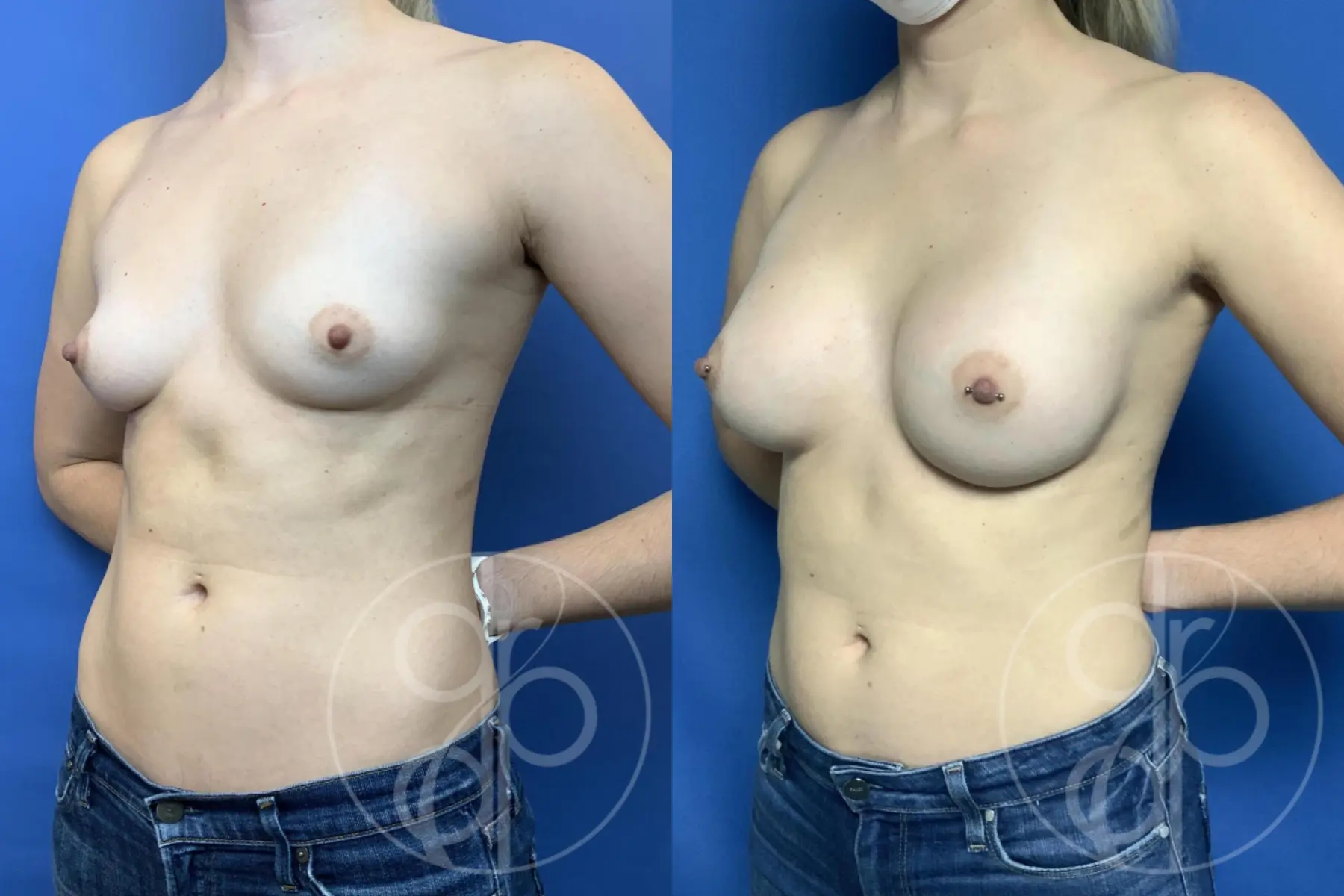 Breast Augmentation: Patient 90 - Before and After 3