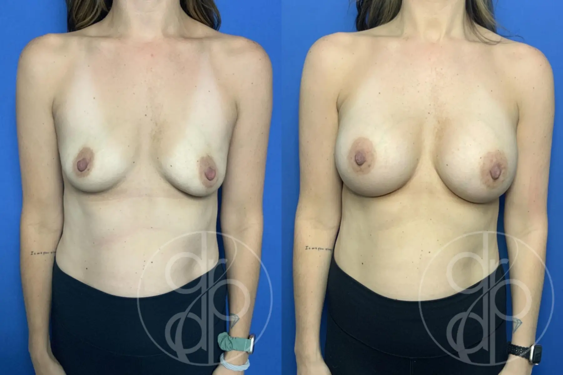 patient 13735 breast augmentation before and after result - Before and After 1