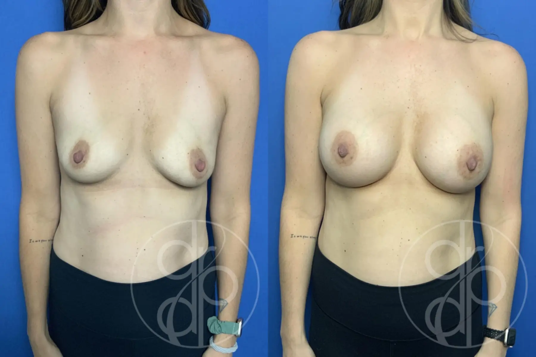 patient 13735 breast augmentation before and after result - Before and After