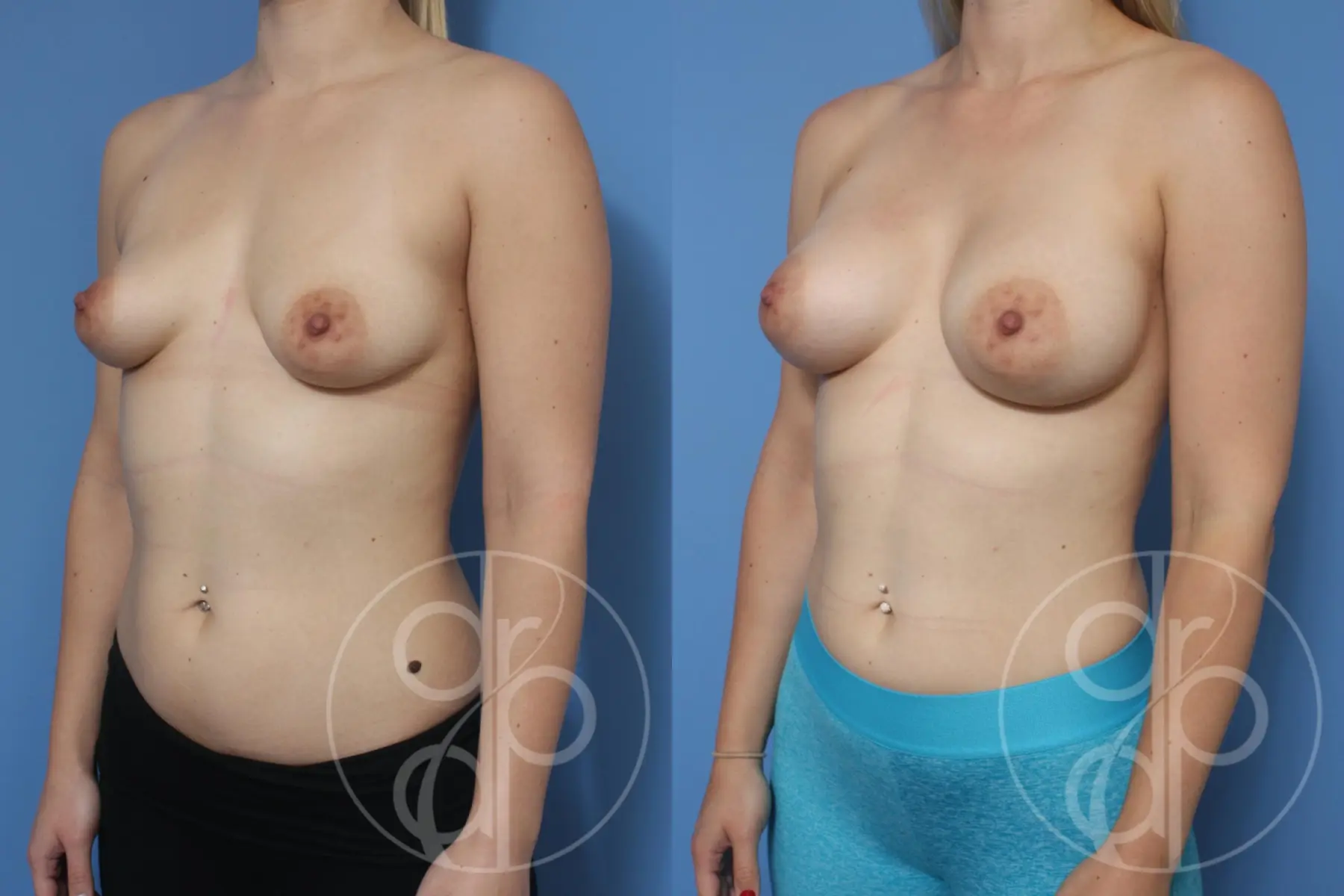 patient 10504 breast augmentation before and after result - Before and After 3