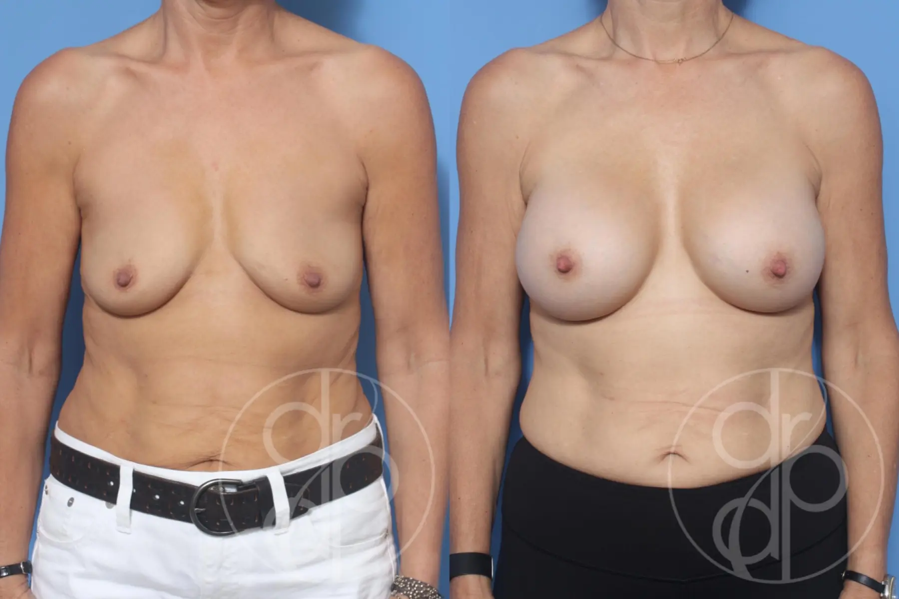 patient 10750 breast augmentation before and after result - Before and After