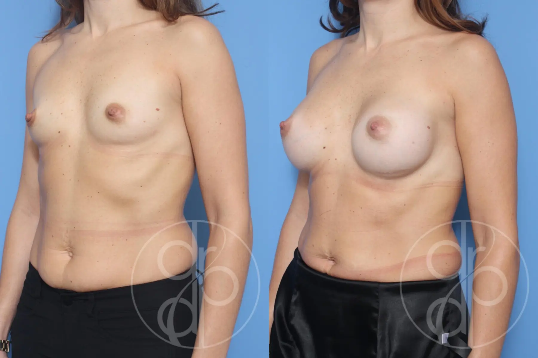 patient 13259 breast augmentation before and after result - Before and After 3