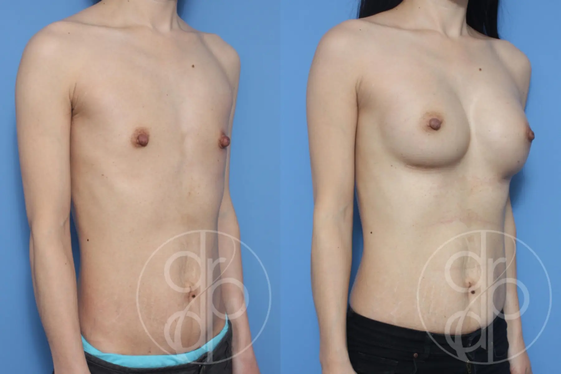 patient 10537 breast augmentation before and after result - Before and After 2