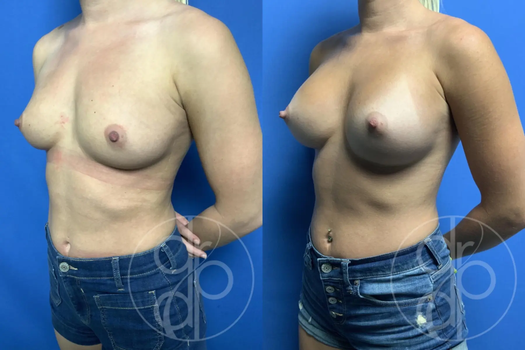 patient 12038 breast augmentation before and after result - Before and After 3