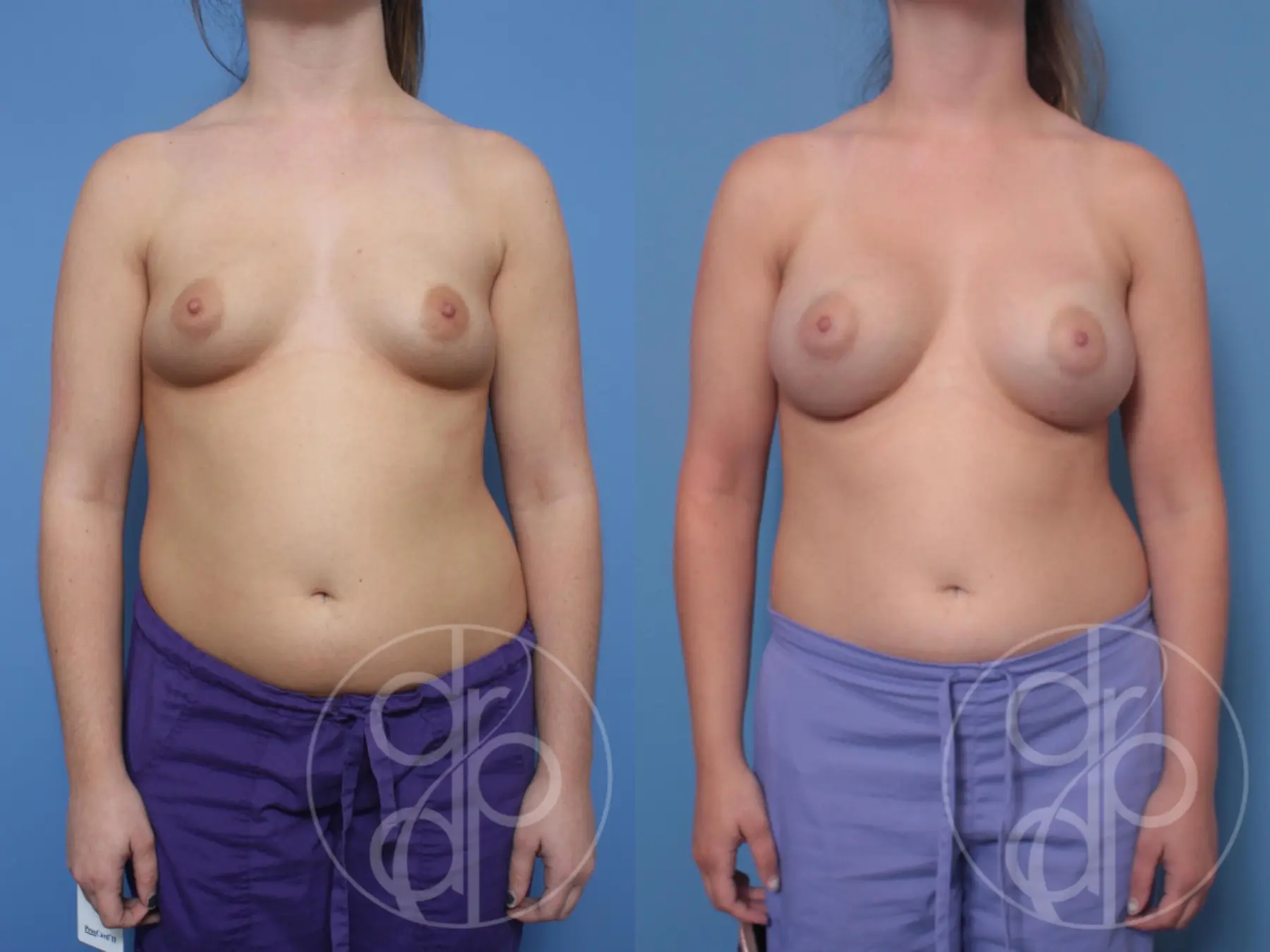 patient 10121 breast augmentation before and after result - Before and After 1