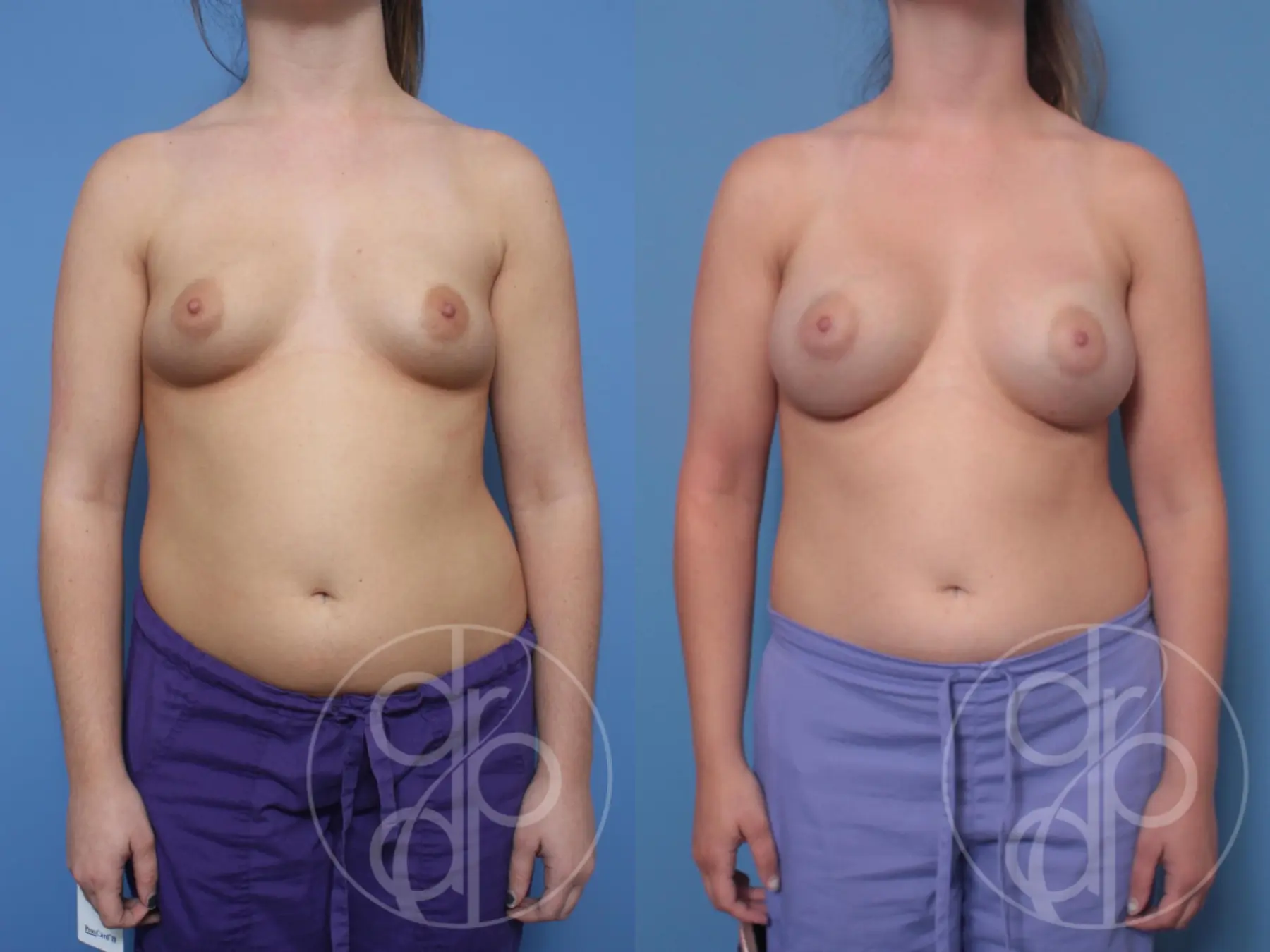 patient 10121 breast augmentation before and after result - Before and After