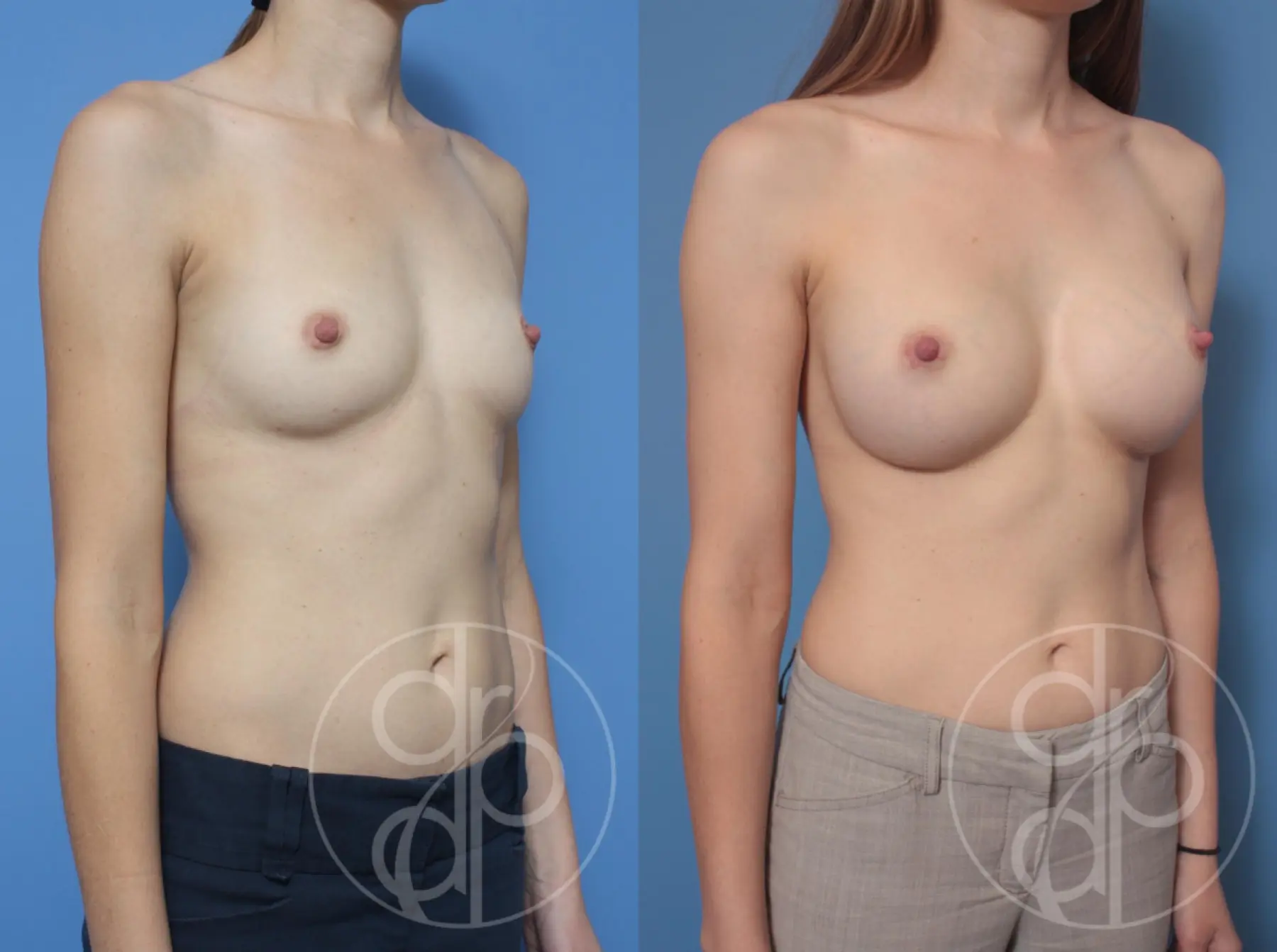 patient 10433 breast augmentation before and after result - Before and After 2
