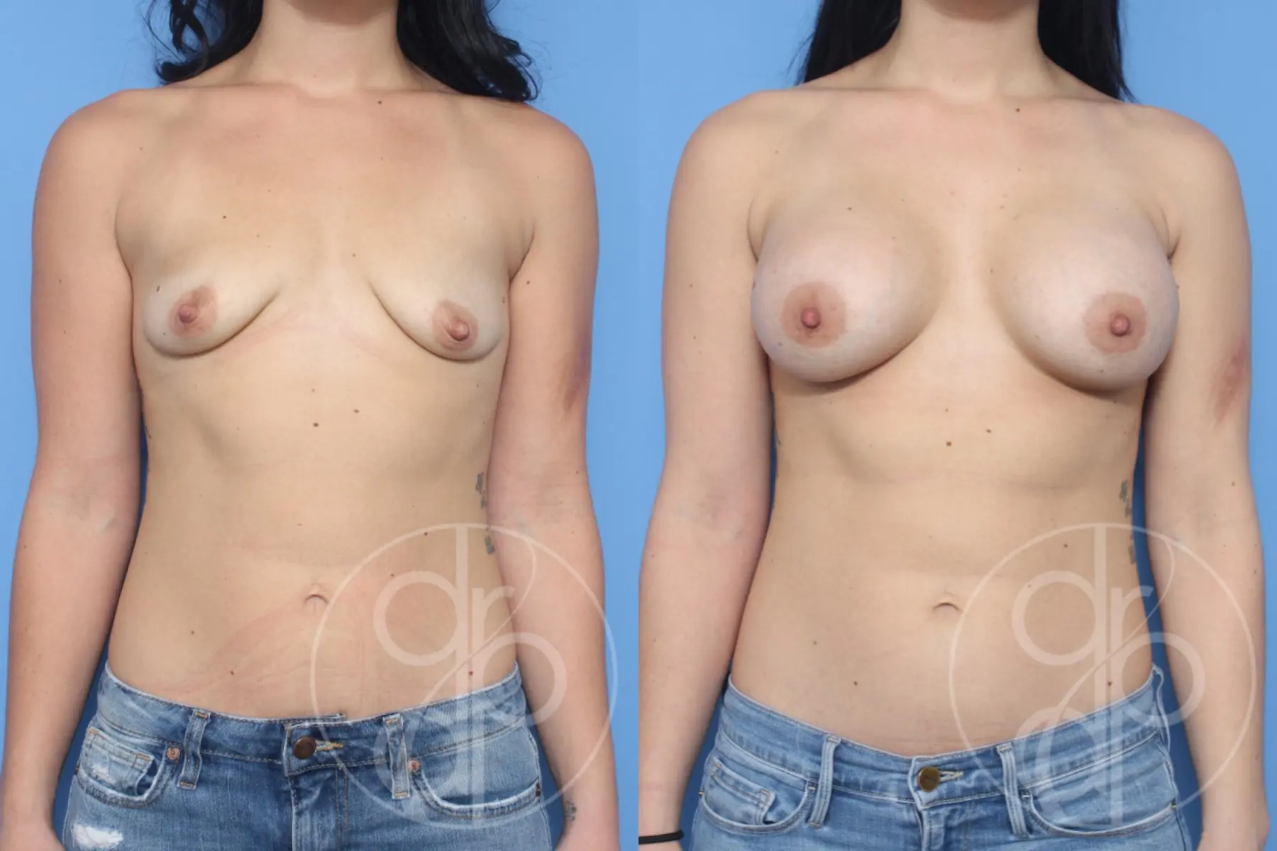 patient 13035 breast augmentation before and after result - Before and After