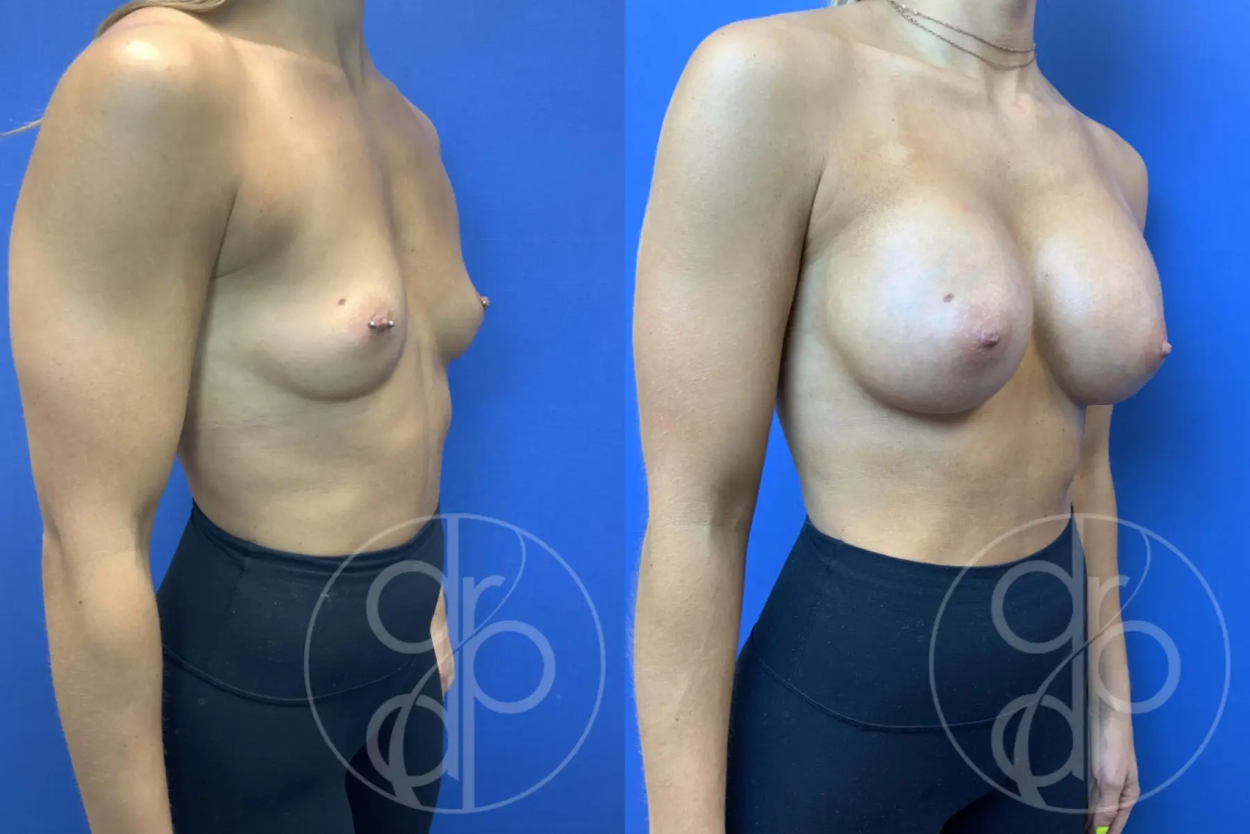 patient 10795 breast augmentation before and after result - Before and After 2