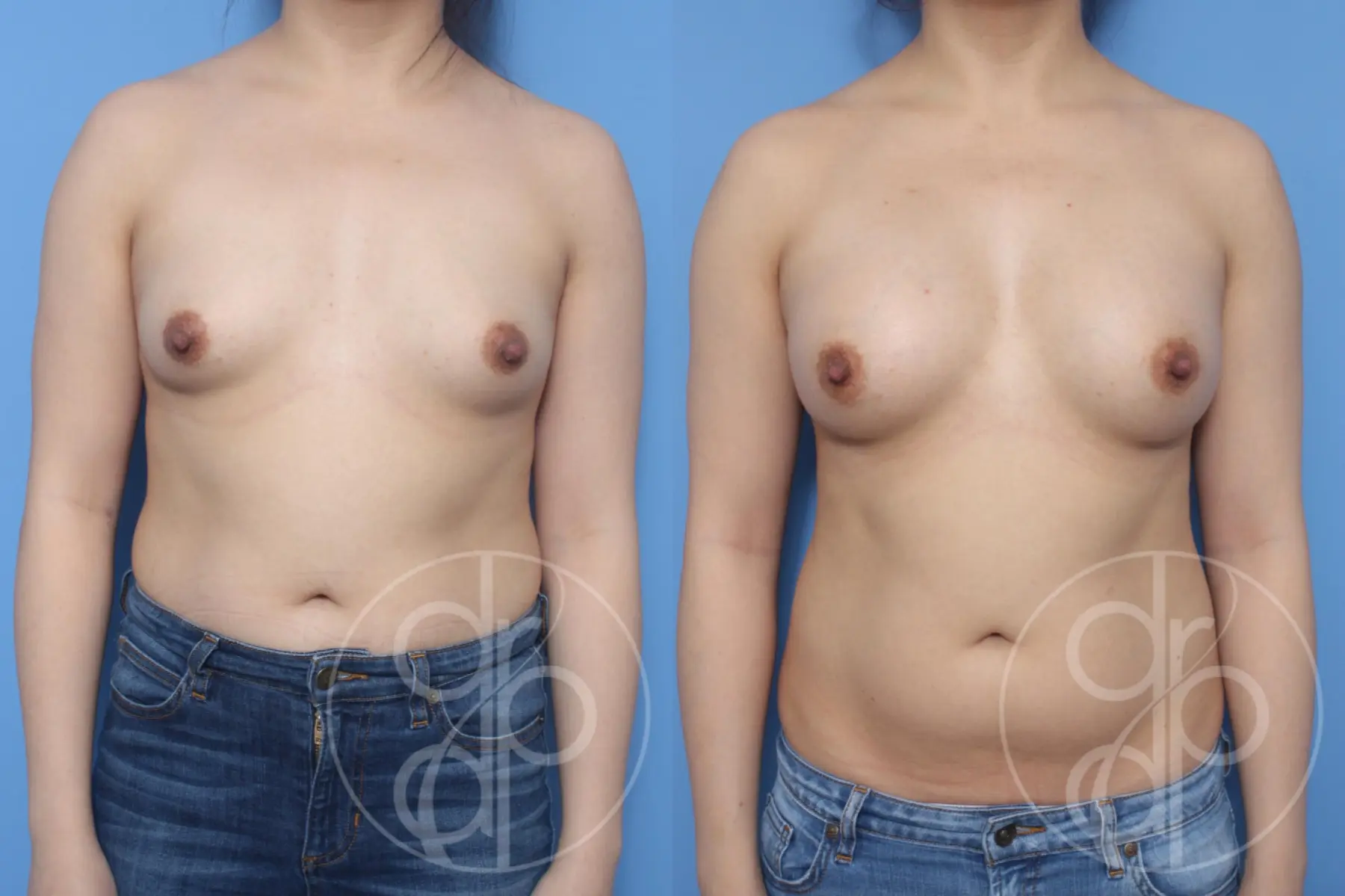 patient 10661 breast augmentation before and after result - Before and After 1