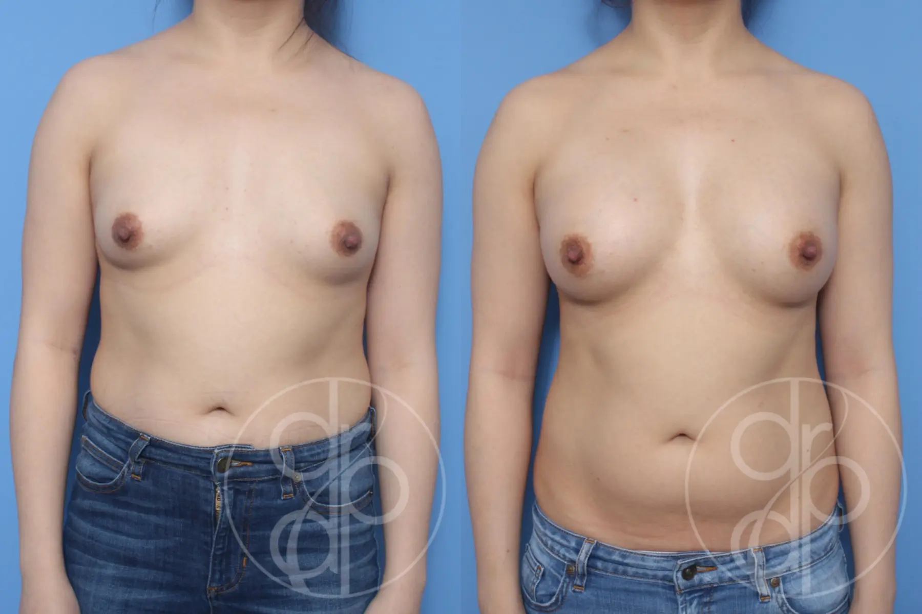 patient 10661 breast augmentation before and after result - Before and After