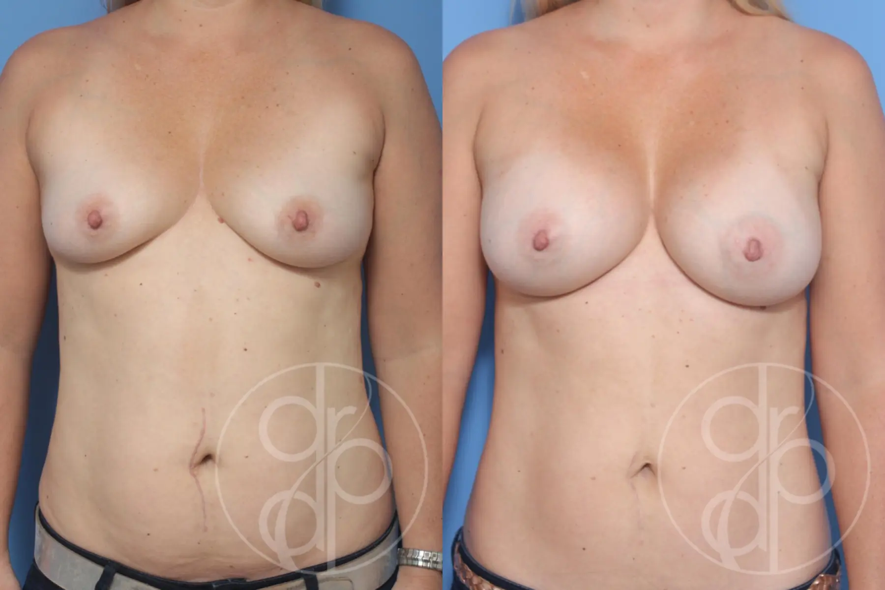 patient 12885 breast augmentation before and after result - Before and After 1