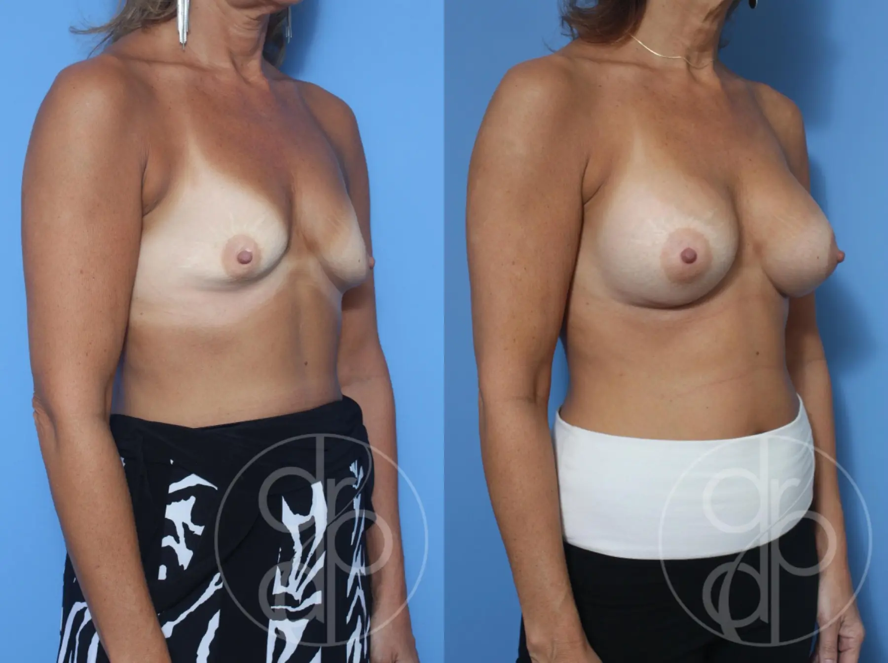 patient 13088 breast augmentation before and after result - Before and After 3