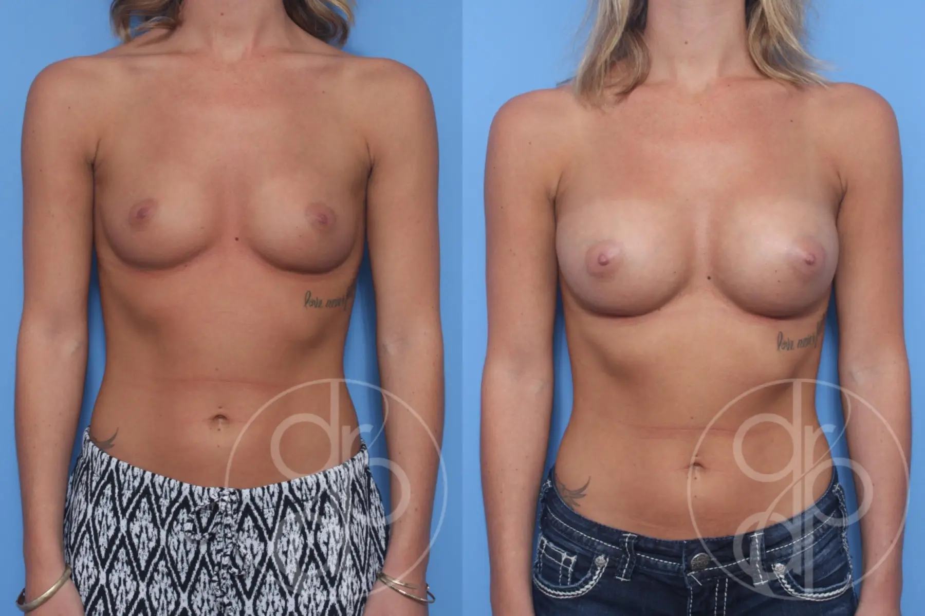 patient 12931 breast augmentation before and after result - Before and After 1