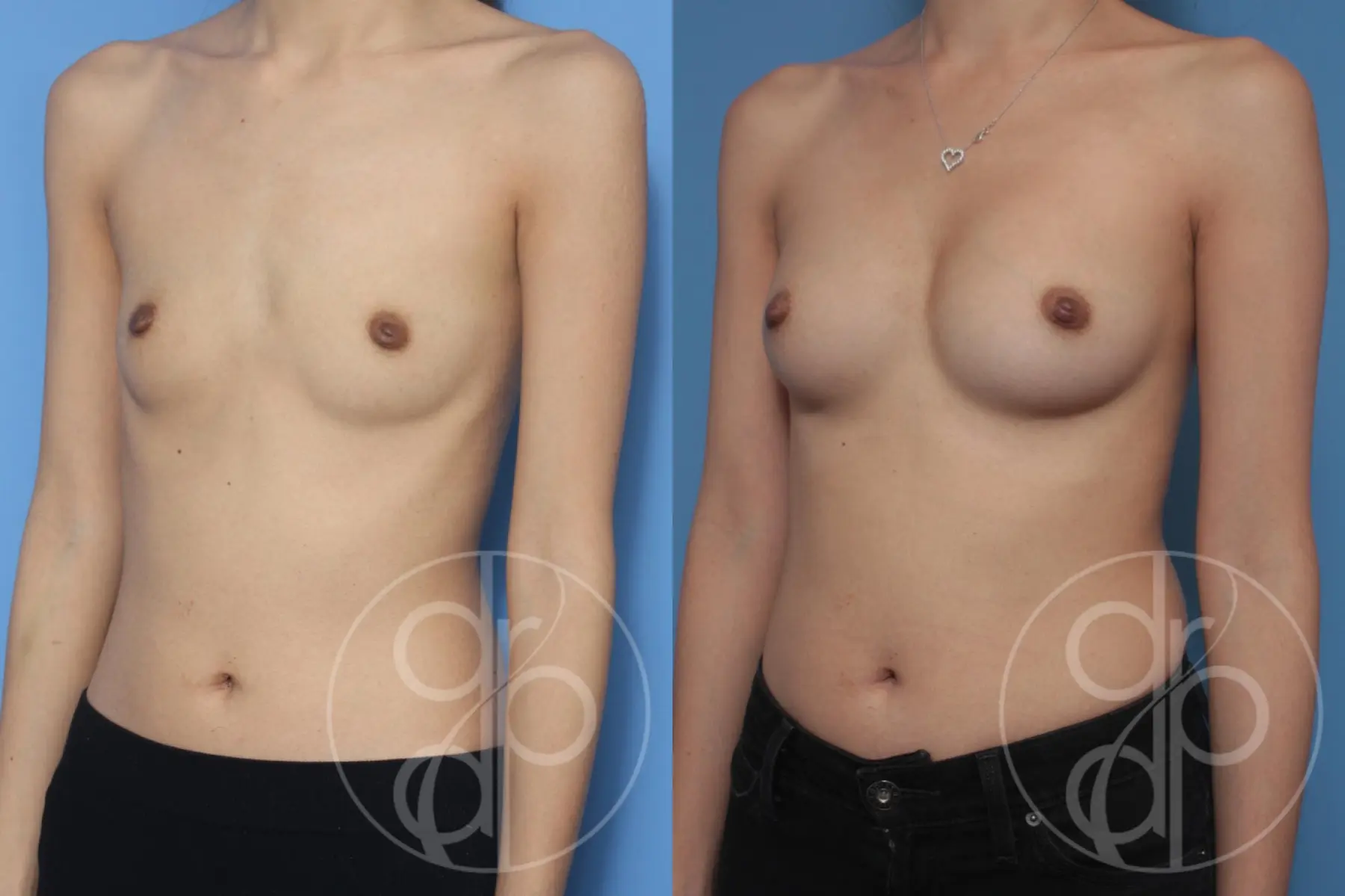 patient 10532 breast augmentation before and after result - Before and After 2