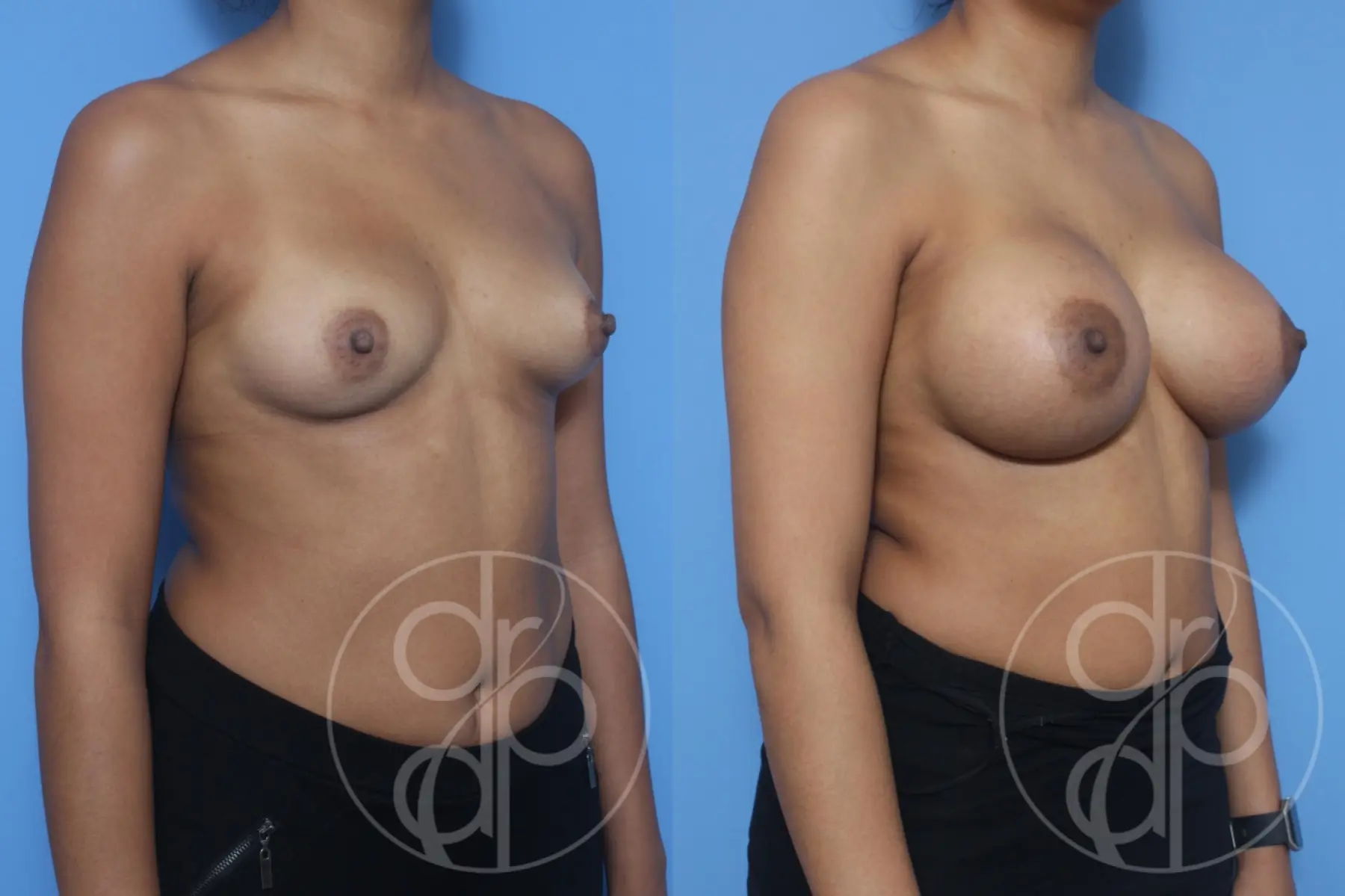 patient 10131 breast augmentation before and after result - Before and After 3