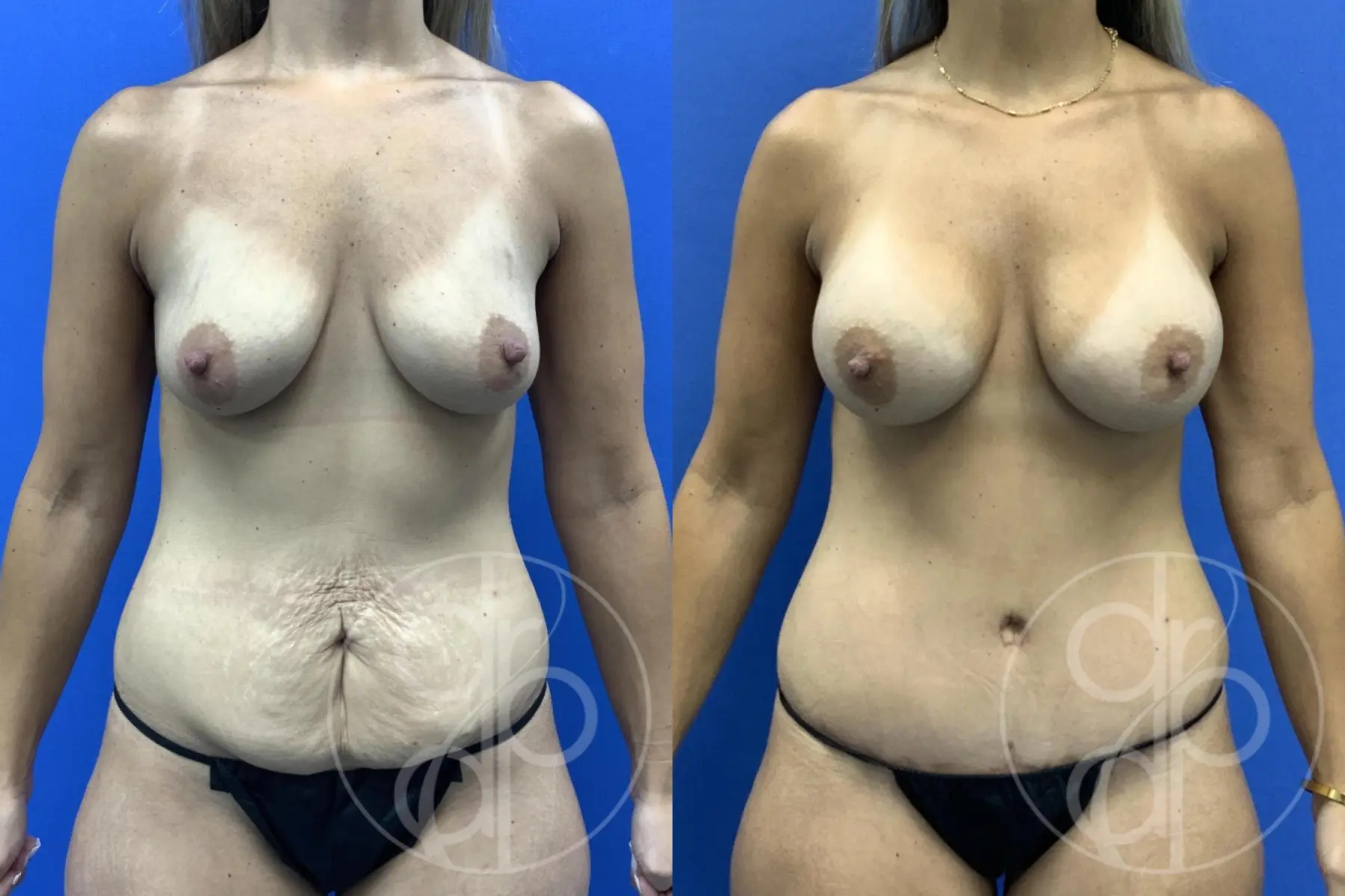 patient 14694 mommy makeover before and after result - Before and After
