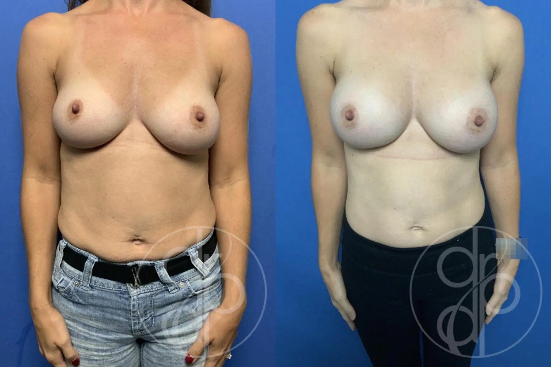 patient 12507 breast augmentation before and after result - Before and After 1
