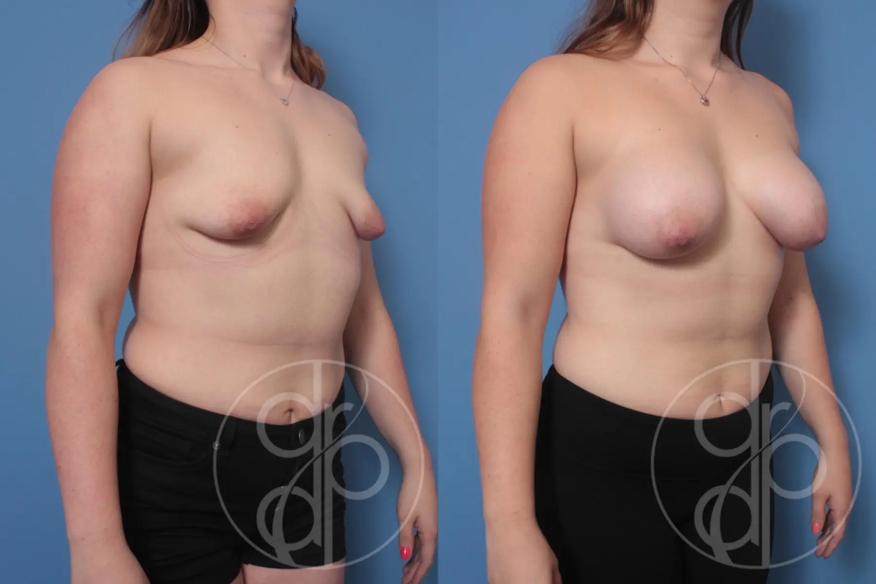 patient 10234 breast augmentation before and after result - Before and After 3
