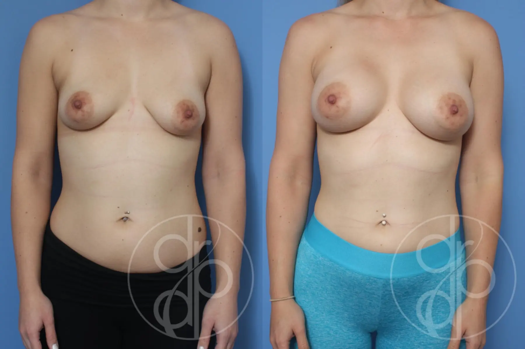 patient 10504 breast augmentation before and after result - Before and After