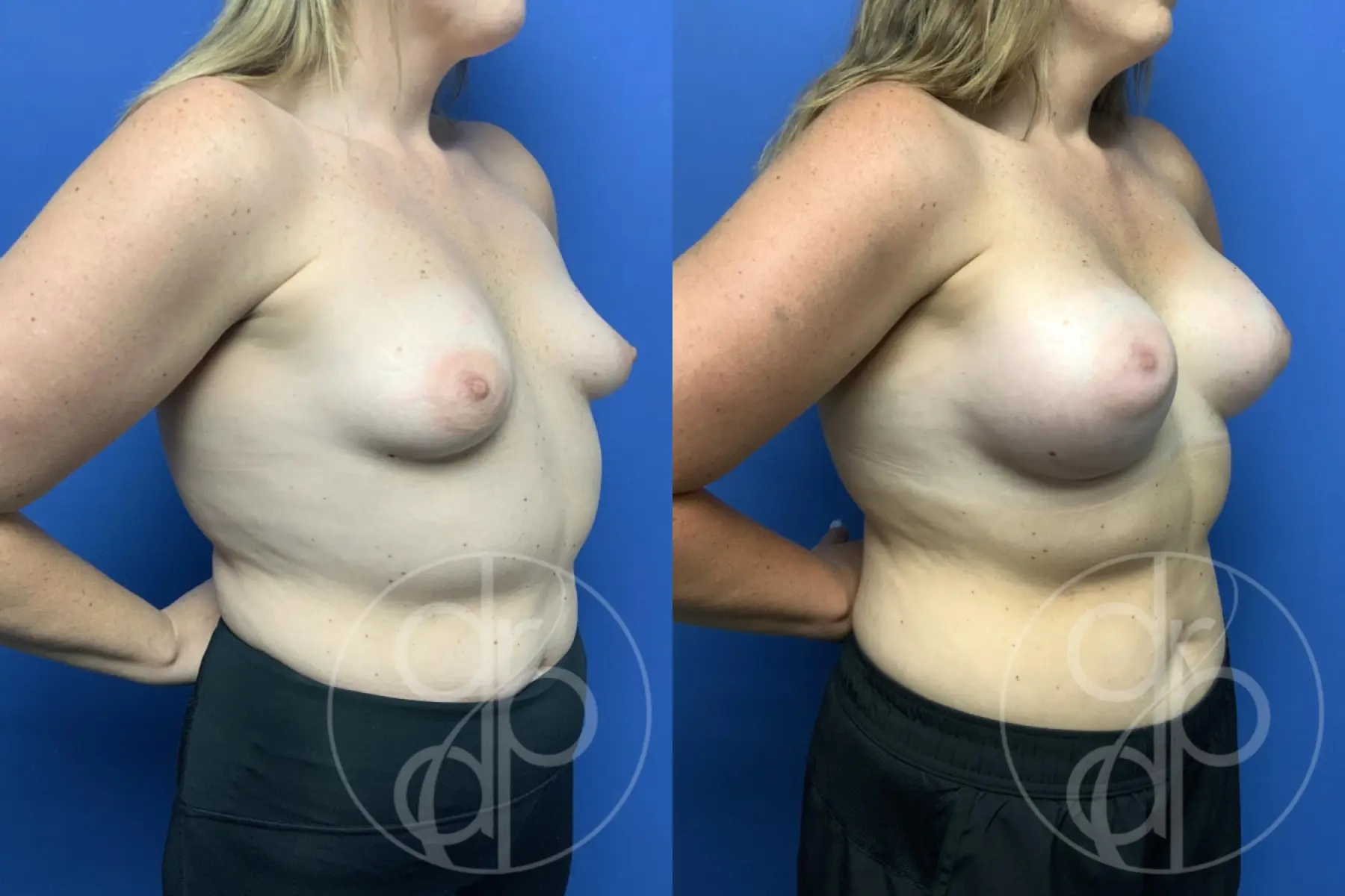 patient 12207 breast augmentation before and after result - Before and After 2