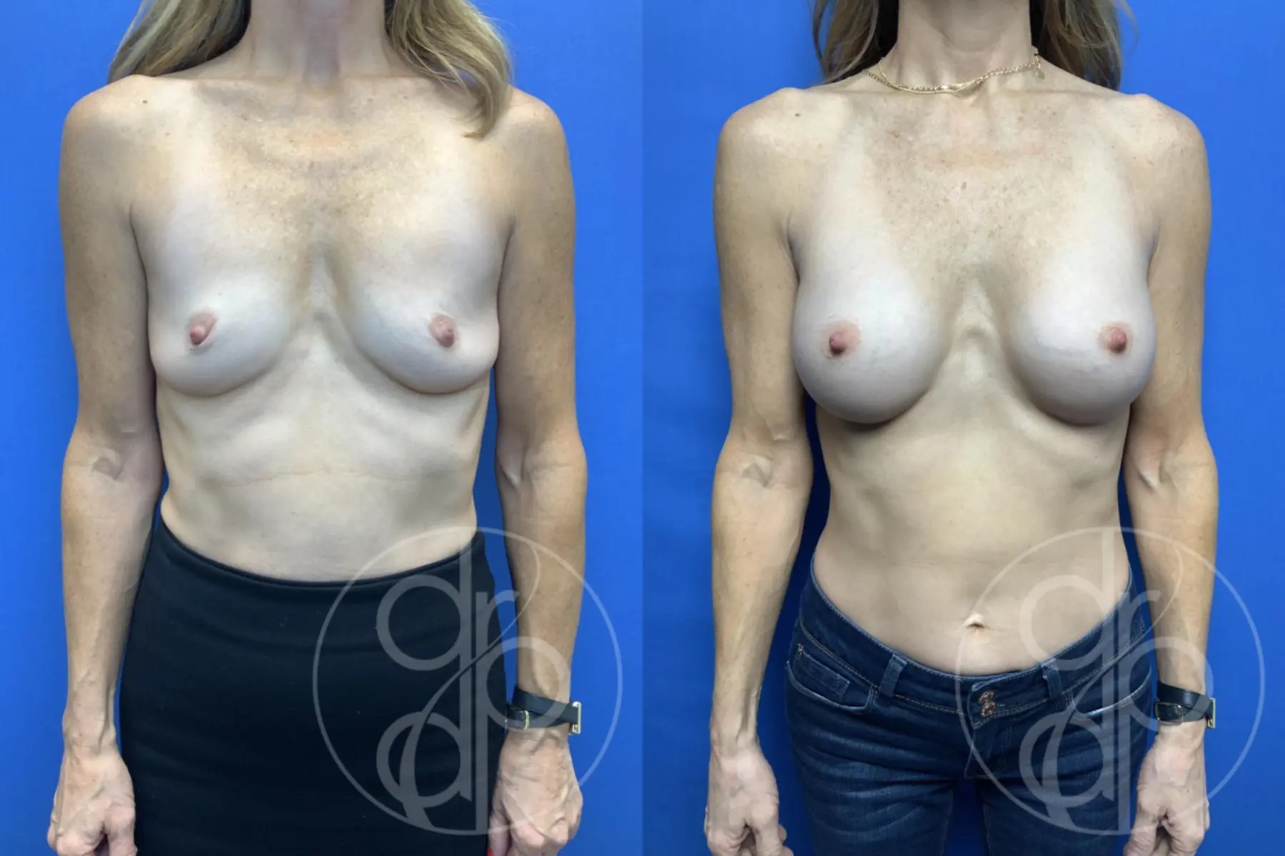 patient 11922 breast augmentation before and after result - Before and After 1