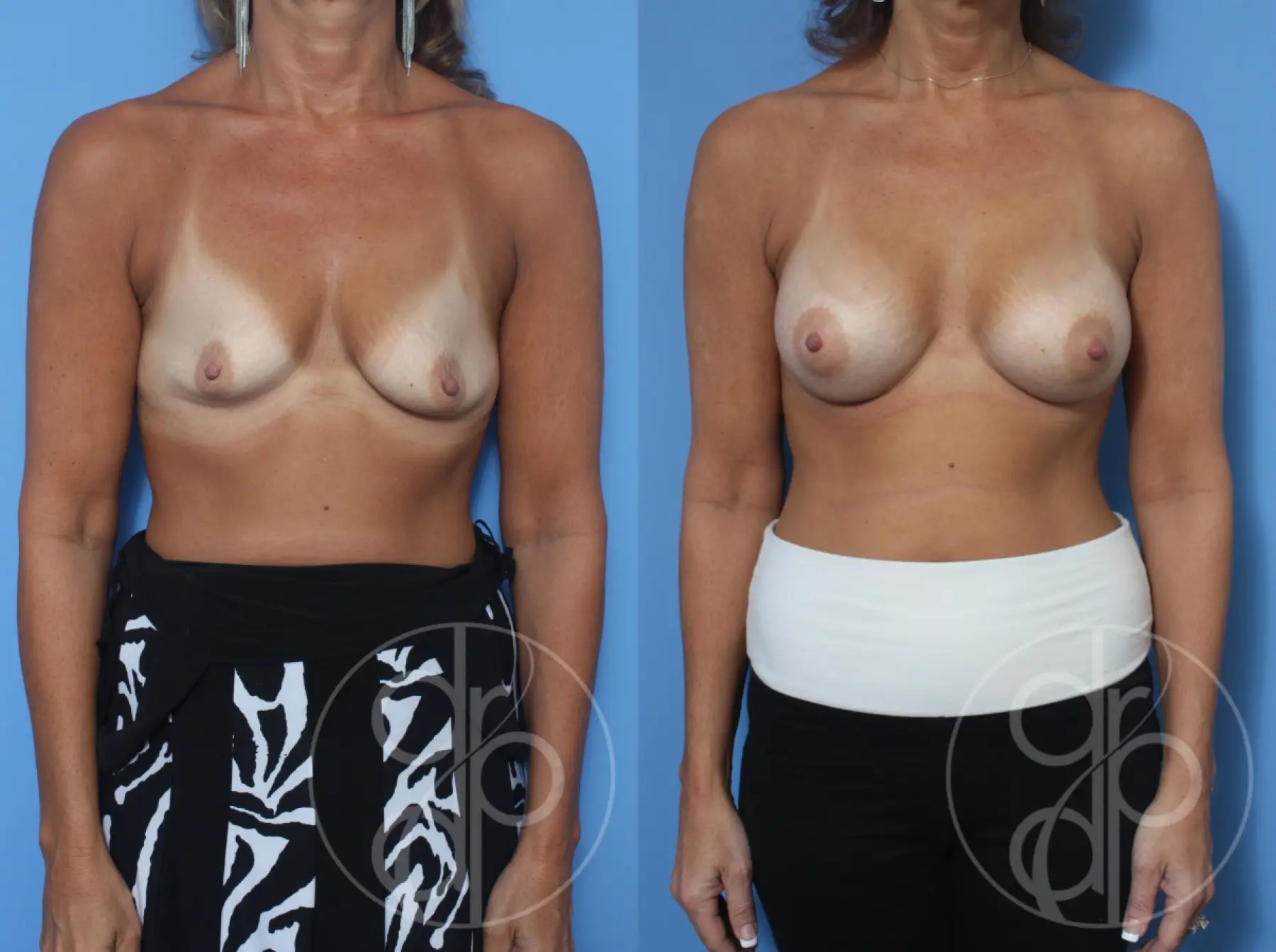 patient 13088 breast augmentation before and after result - Before and After 1