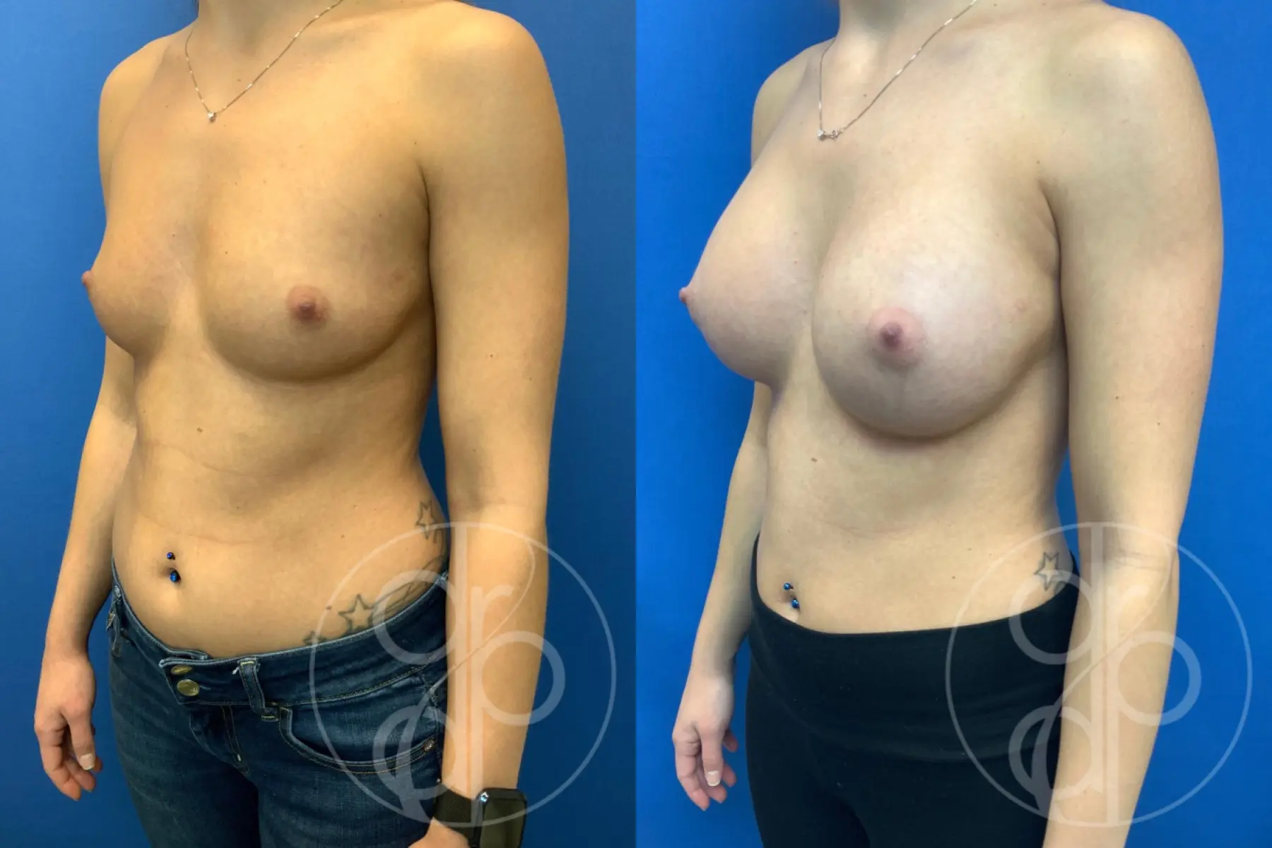 patient 10657 breast augmentation before and after result - Before and After 3