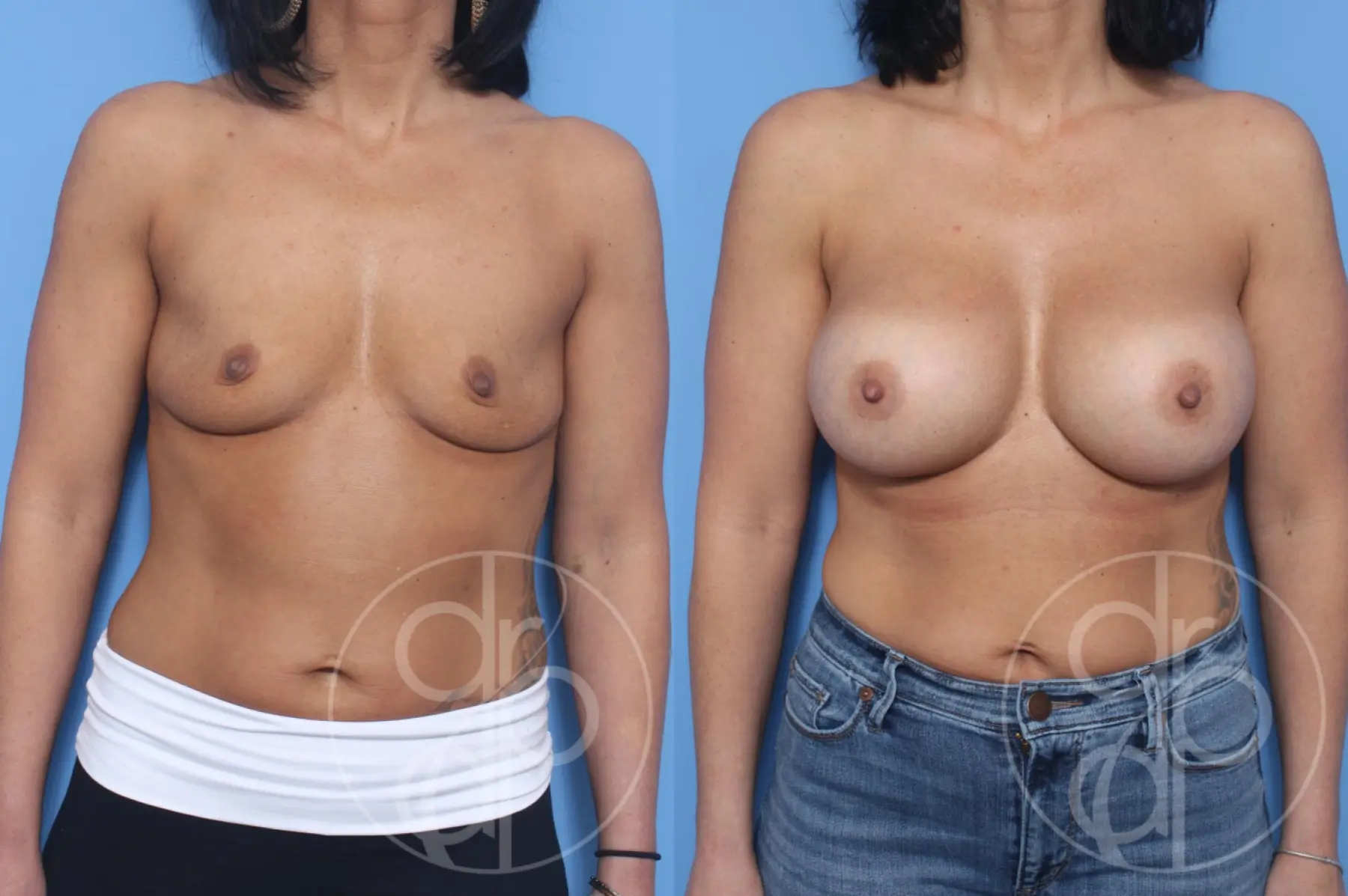 patient 12298 breast augmentation before and after result - Before and After