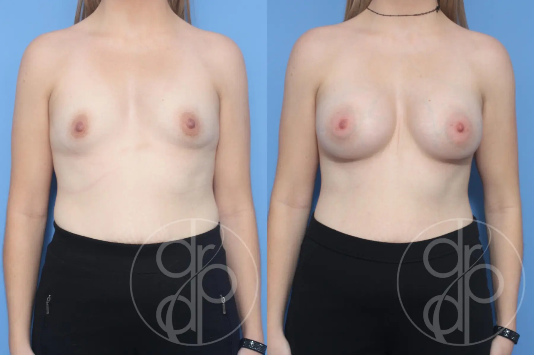 patient 13235 breast augmentation before and after result - Before and After 1