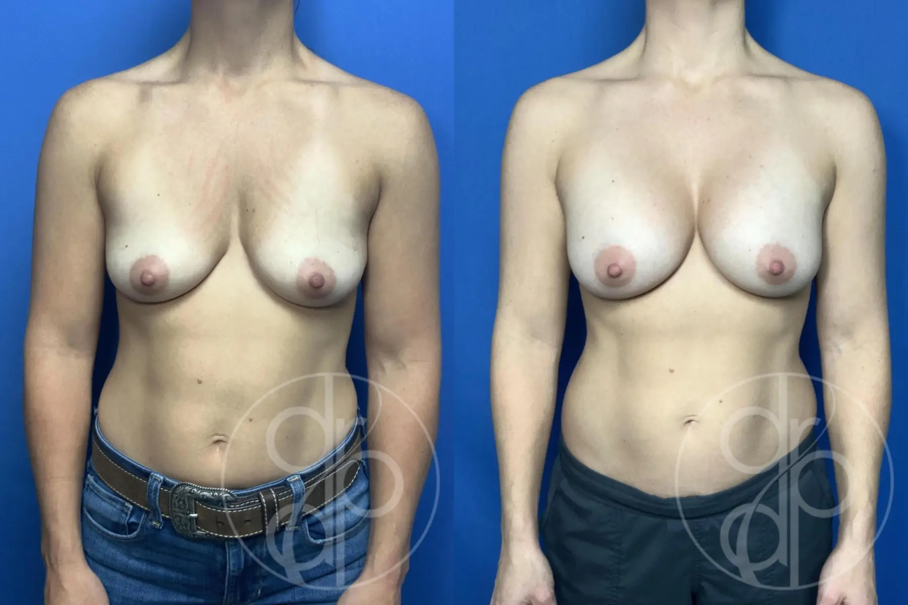 Breast Augmentation: Patient 93 - Before and After 1