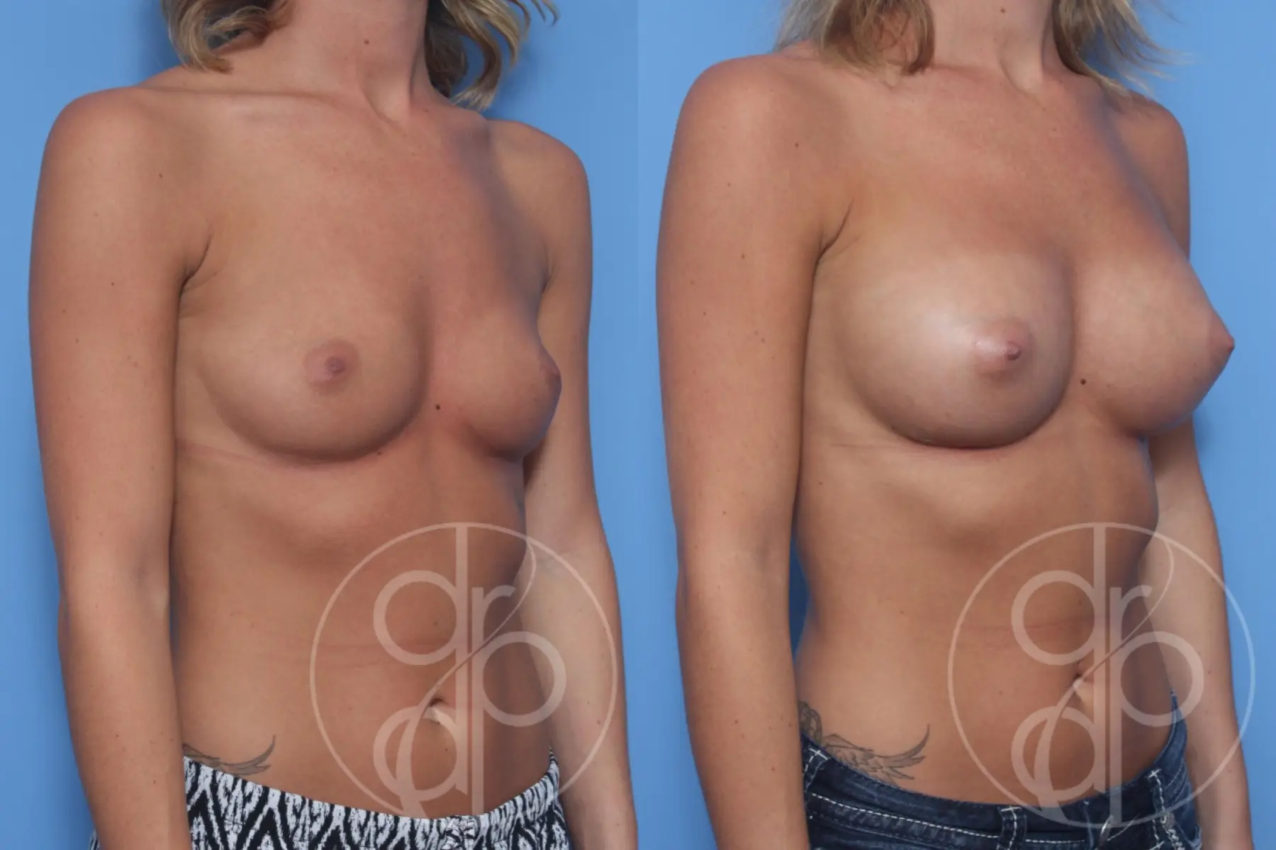patient 12931 breast augmentation before and after result - Before and After 2