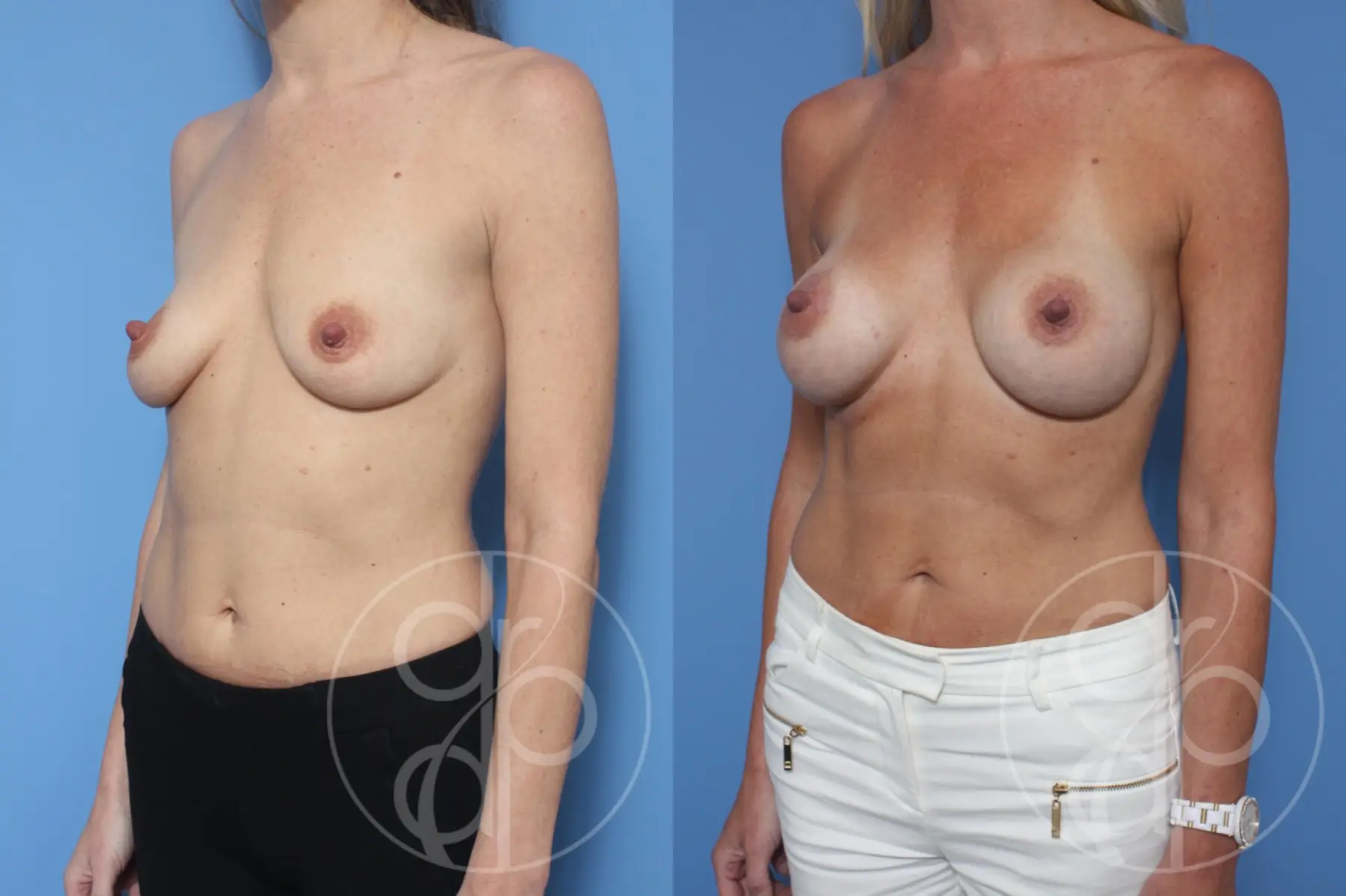 patient 13174 breast augmentation before and after result - Before and After 3