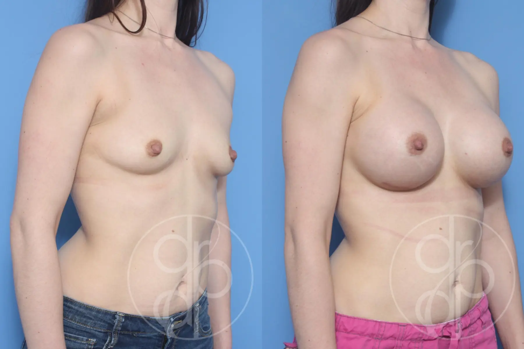 patient 13262 breast augmentation before and after result - Before and After 3