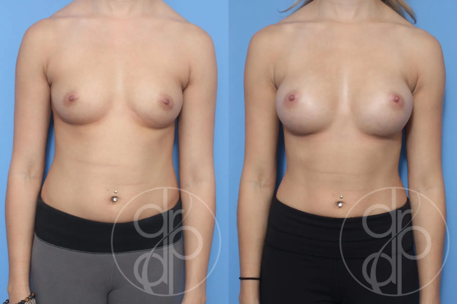 patient 12591 breast augmentation before and after result - Before and After 1