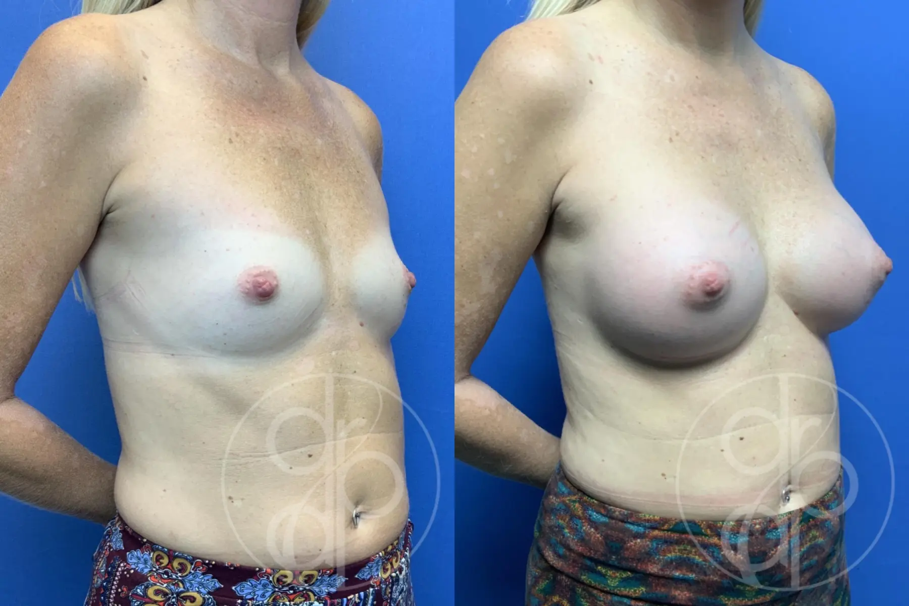patient 10644 breast augmentation before and after result - Before and After 2