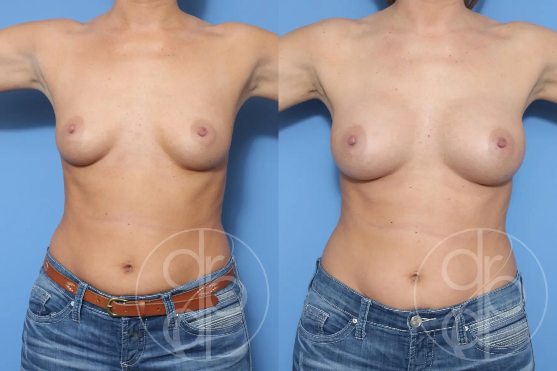 patient 10552 breast augmentation before and after result - Before and After