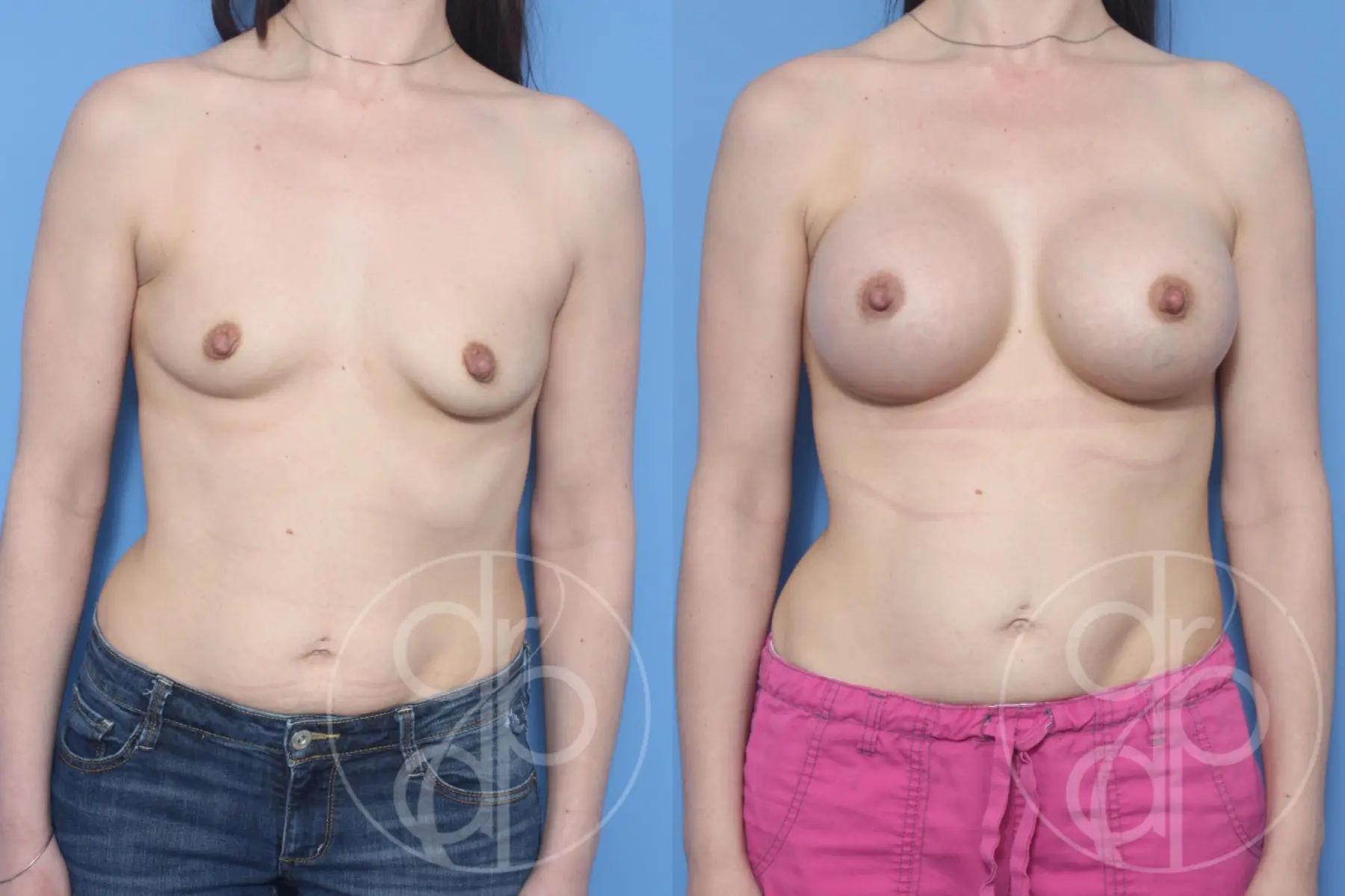 patient 13262 breast augmentation before and after result - Before and After 1