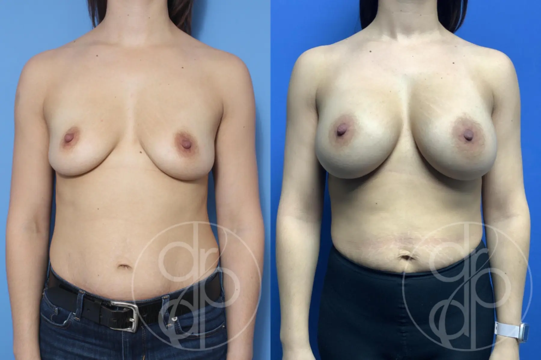 patient 10291 breast augmentation before and after result - Before and After