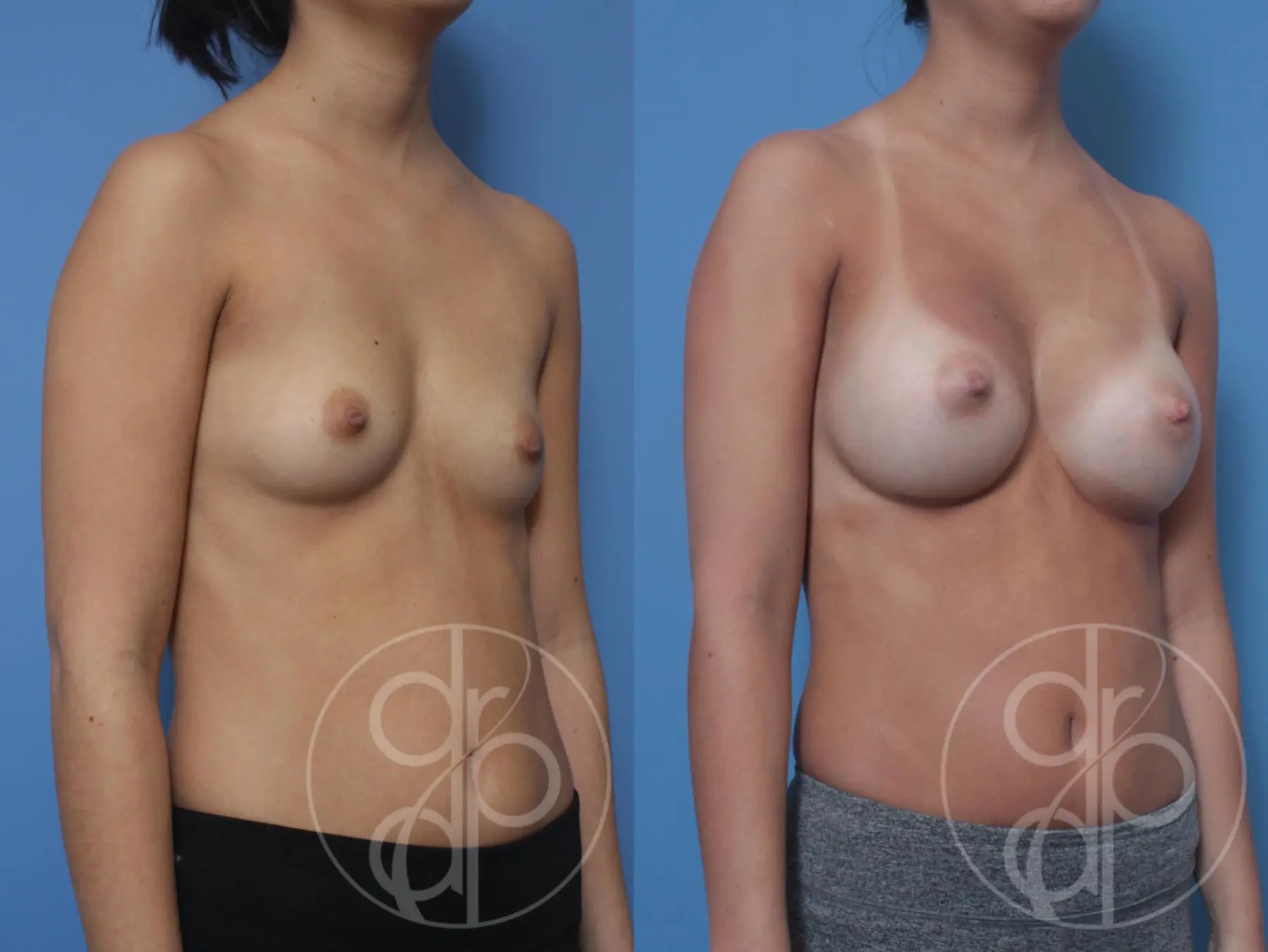 patient 10303 breast augmentation before and after result - Before and After 3