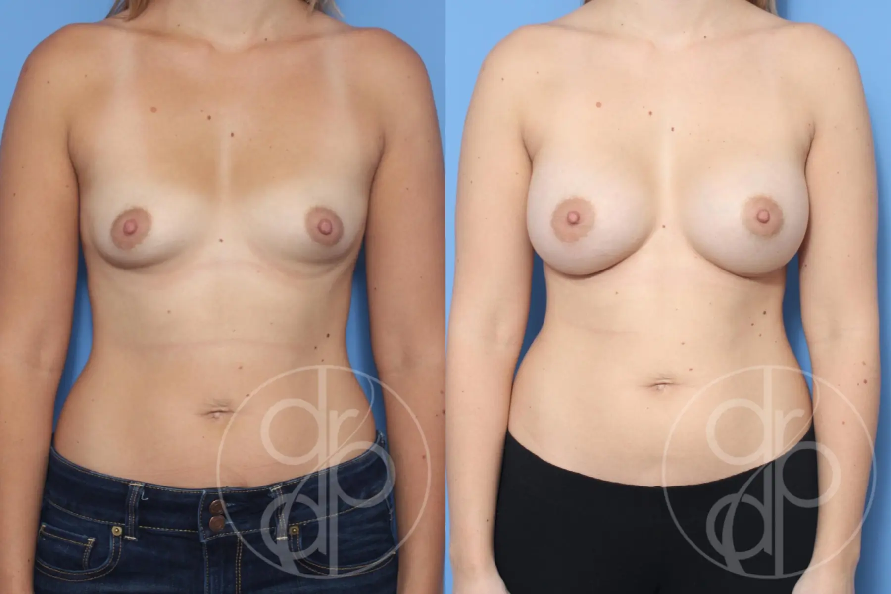 patient 12528 breast augmentation before and after result - Before and After 1