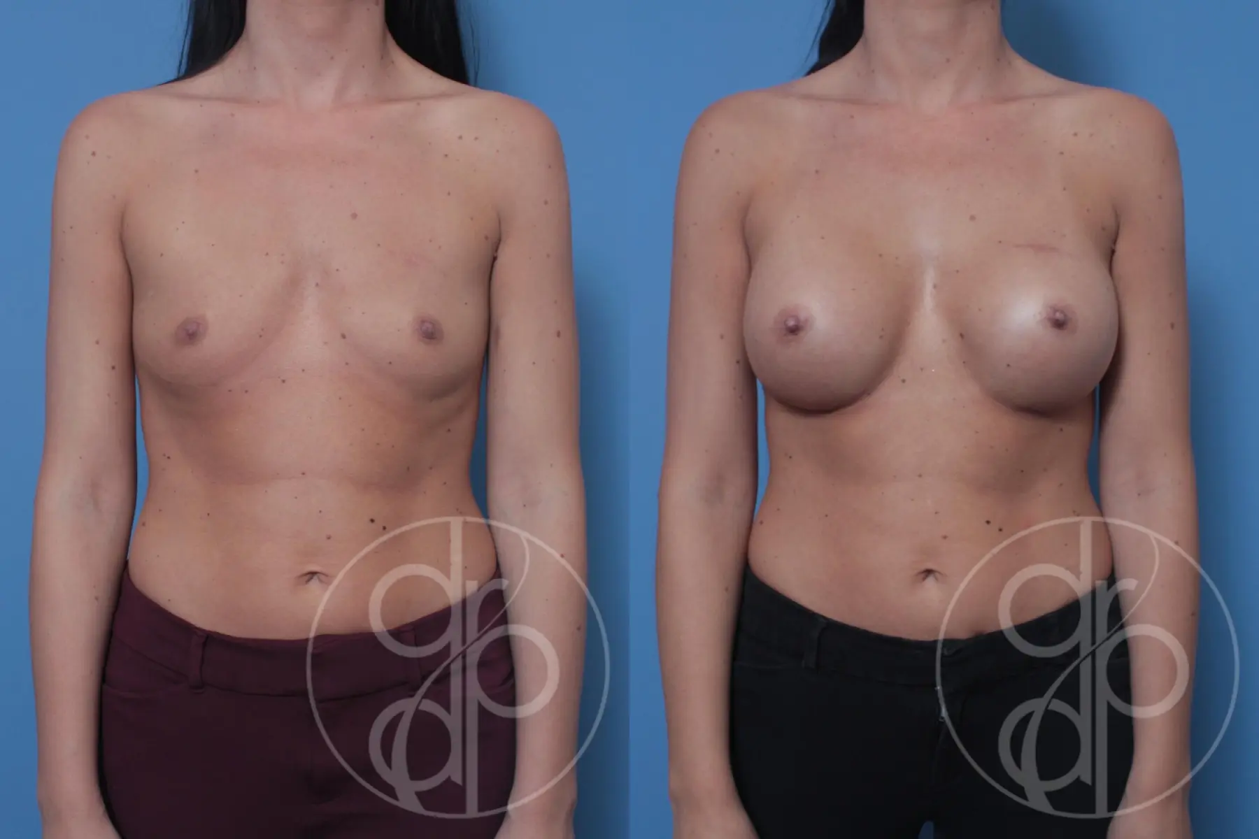 patient 10585 breast augmentation before and after result - Before and After 1