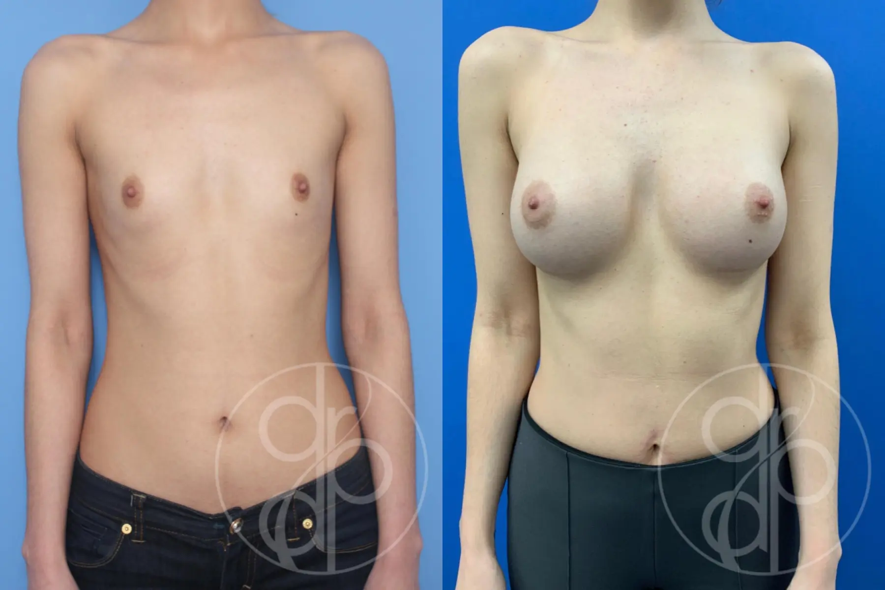 patient 10637 breast augmentation before and after result - Before and After 1