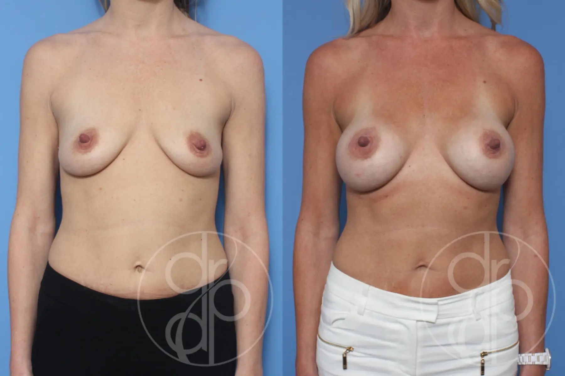 patient 13174 breast augmentation before and after result - Before and After 1