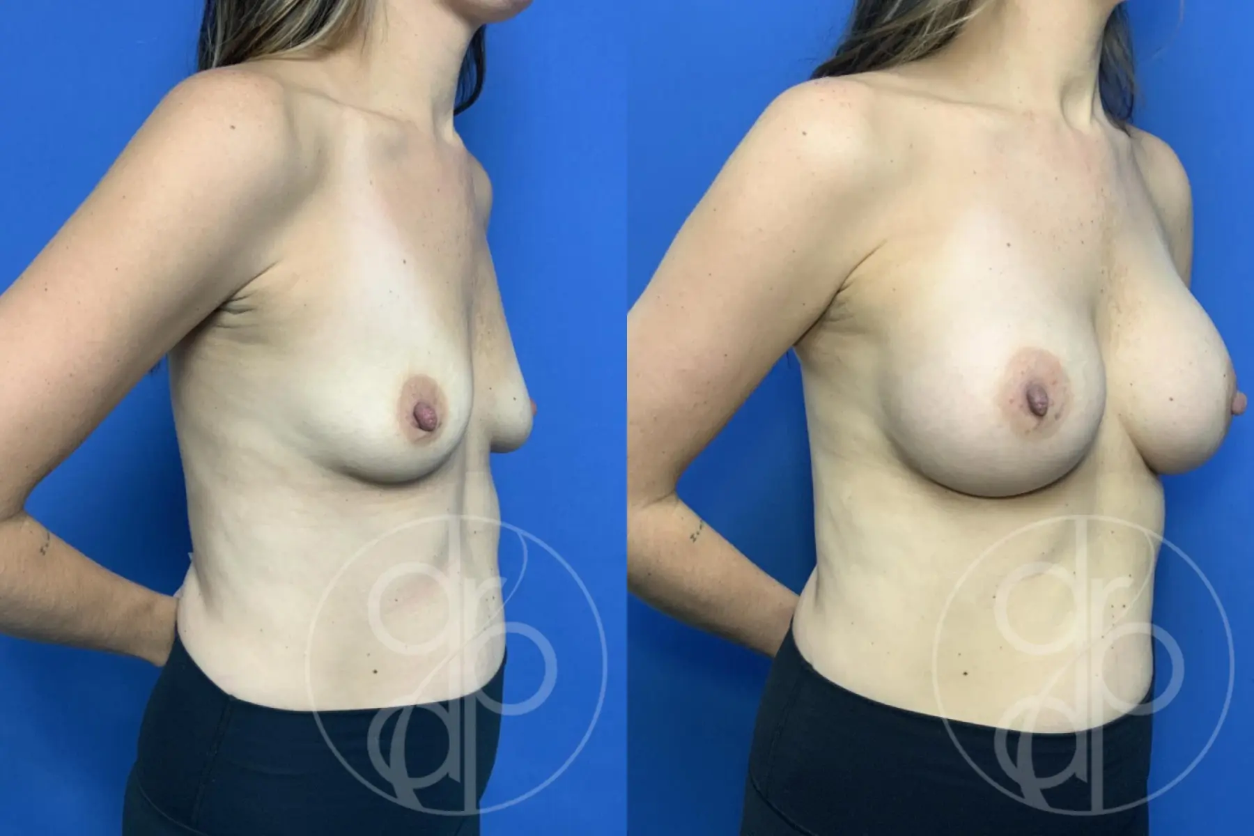 patient 13735 breast augmentation before and after result - Before and After 2