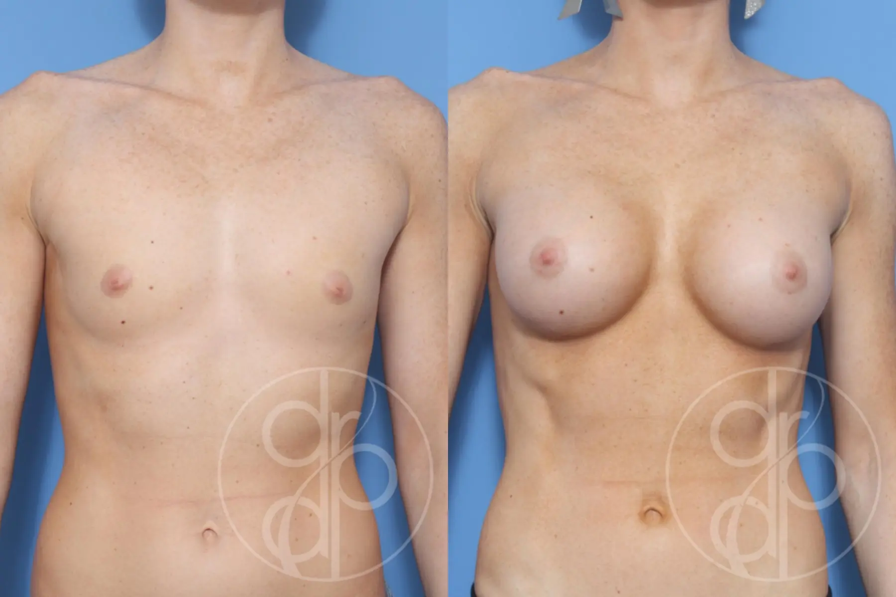 patient 11885 breast augmentation before and after result - Before and After 1